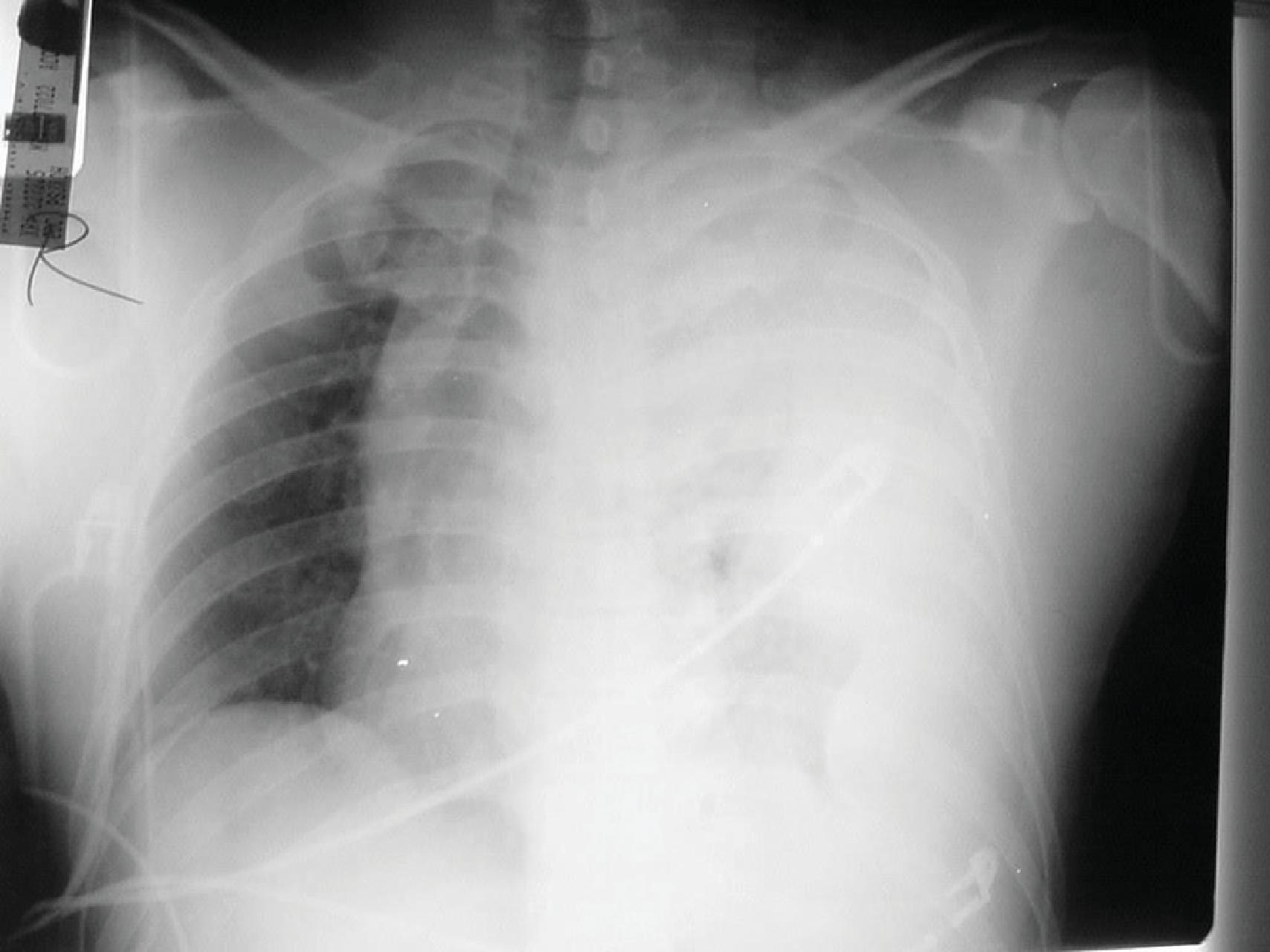 FIG. 5, Massive hemothorax with tension component. Note the tracheal deviation to the right side and marked opacification of the left hemithorax.