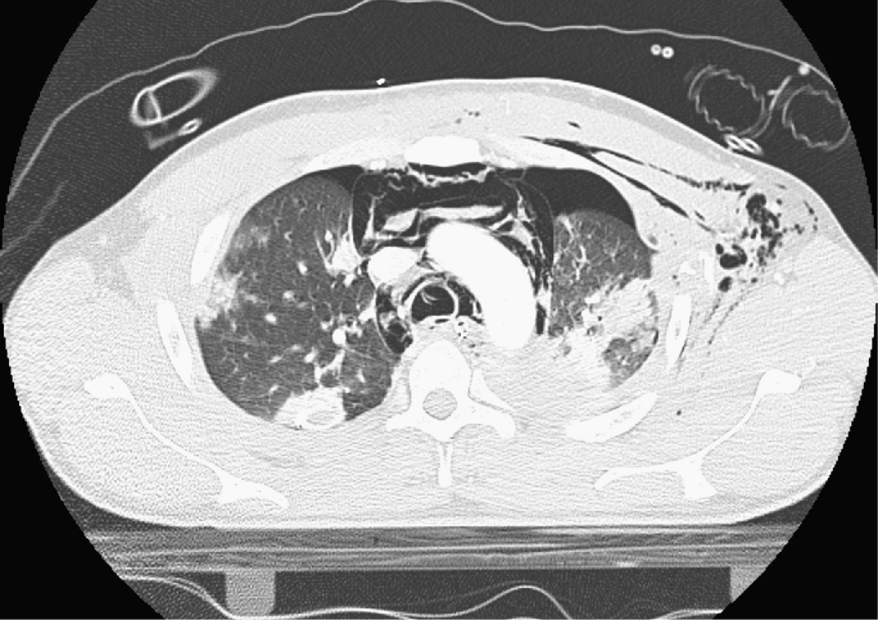 FIG. 1, CT scan of the chest showing rib fractures, bilateral pulmonary contusions, bilateral pneumothoraces, left hemothorax, and left subcutaneous emphysema.