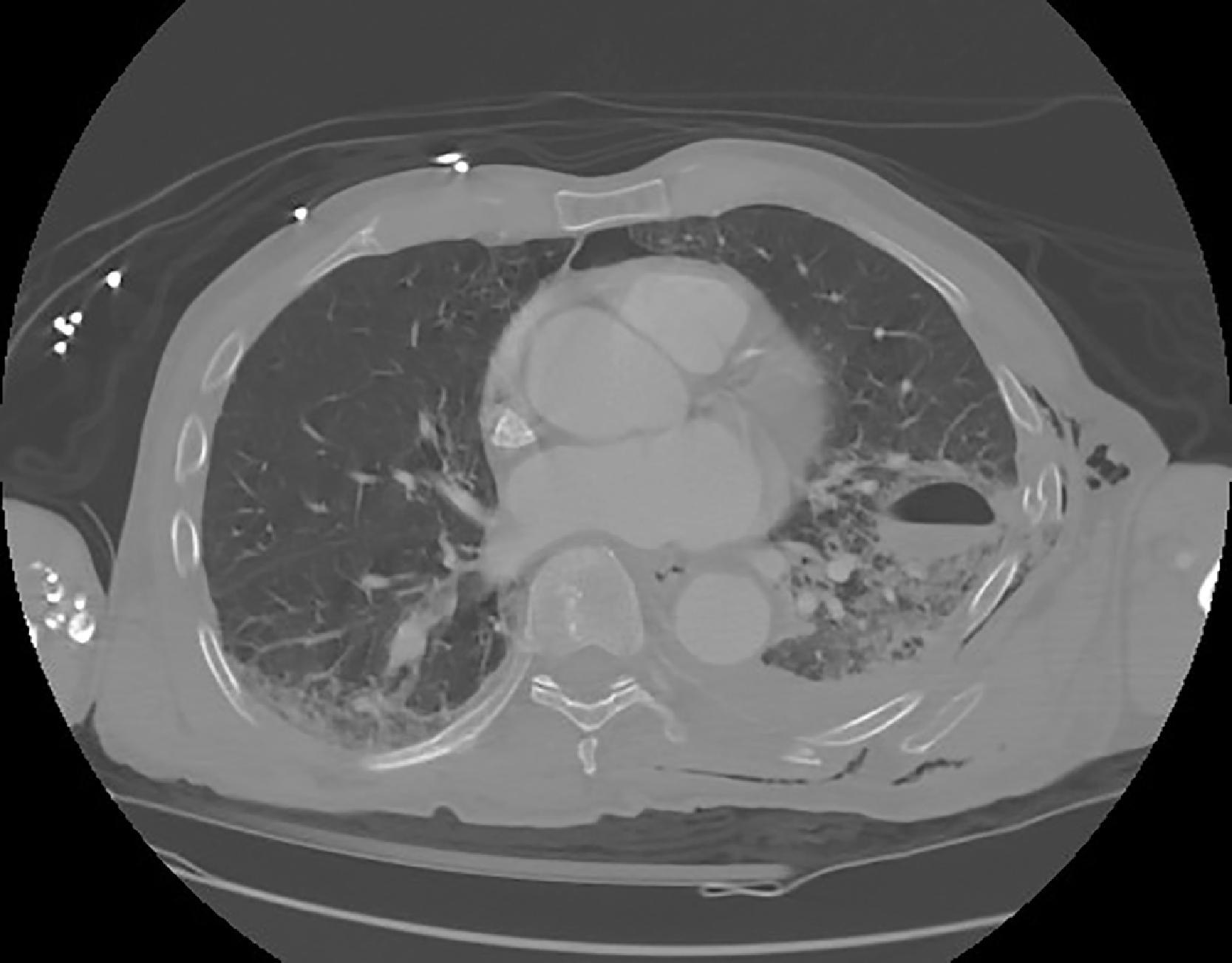 FIG. 2, Large left pneumatocele, hemothorax, subcutaneous emphysema, rib fractures, and pulmonary contusions after a blunt assault inflicted by beating with a golf club.