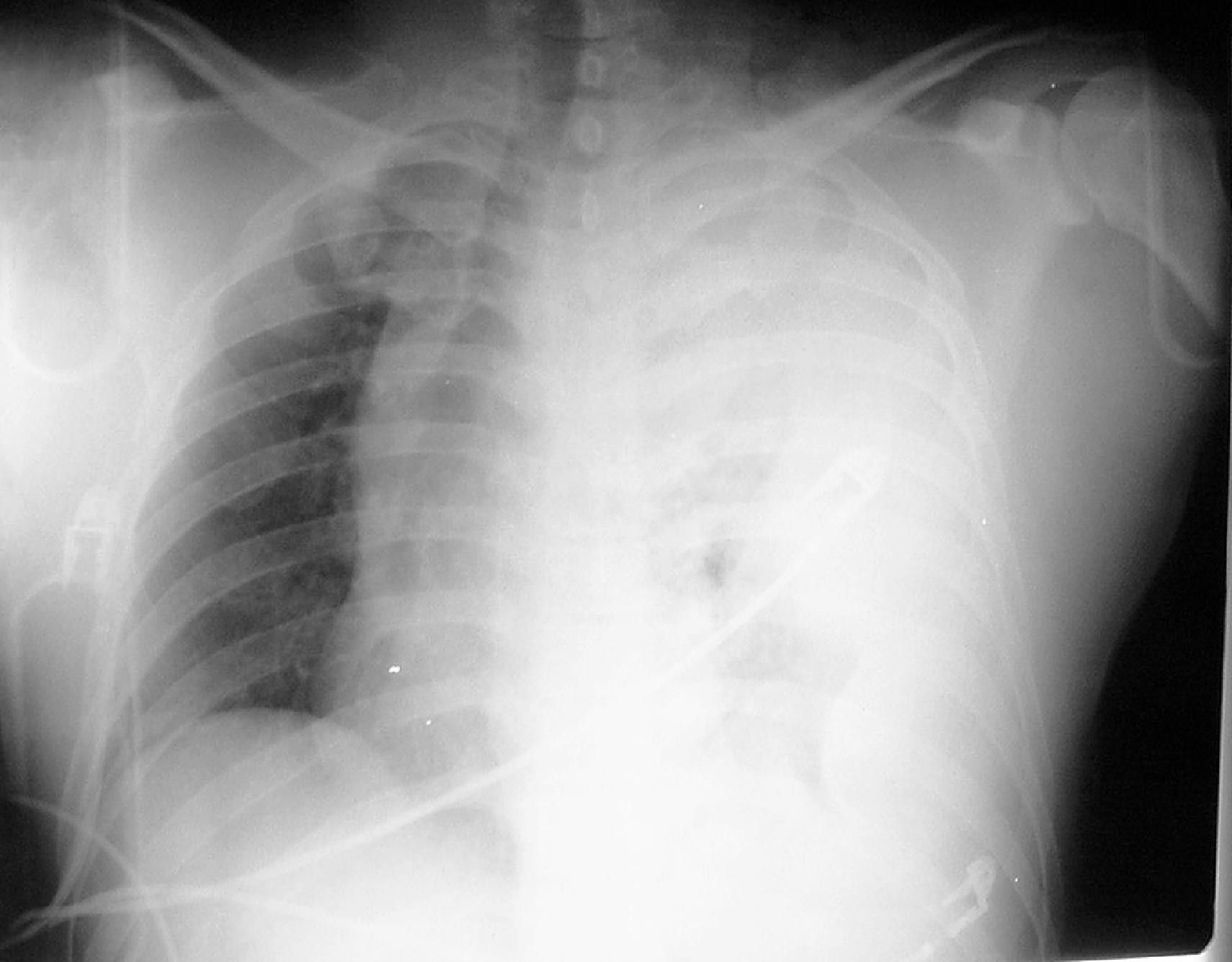 FIG. 3, Chest radiograph demonstrating large left-sided tension hemothorax with complete opacification and tracheal deviation.