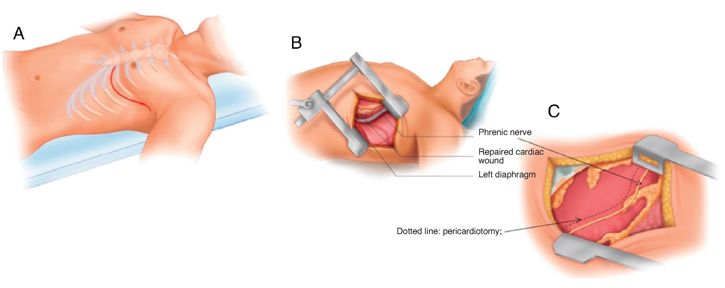 FIG. 4, Surgical approach for ED thoracotomy showing curvilinear initial incision (A) , placement of rib retractor (B) , and location for pericardotomy in relation to phrenic nerve (C).