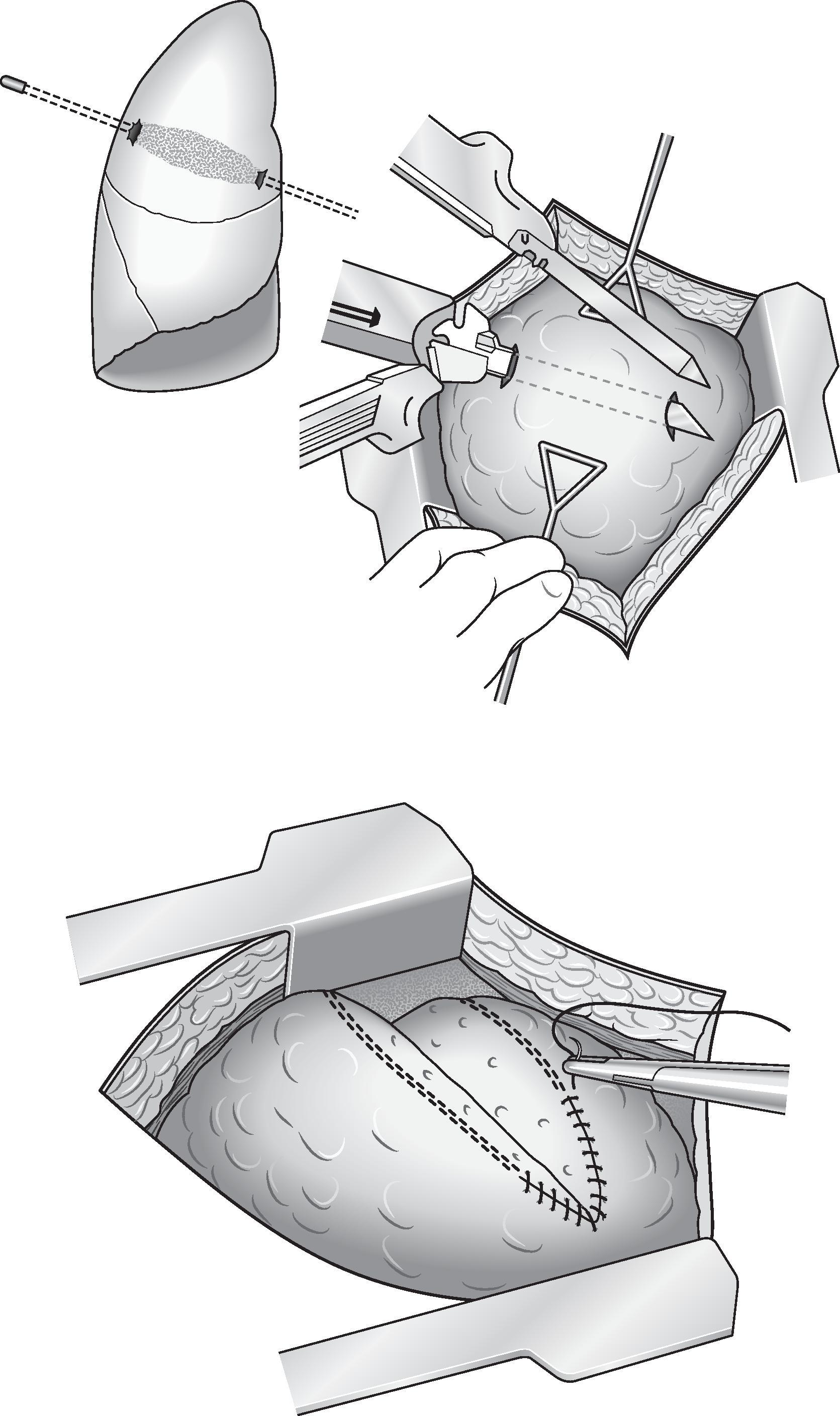 FIG. 6, Operative photo after clamshell thoracotomy and right pneumonectomy.