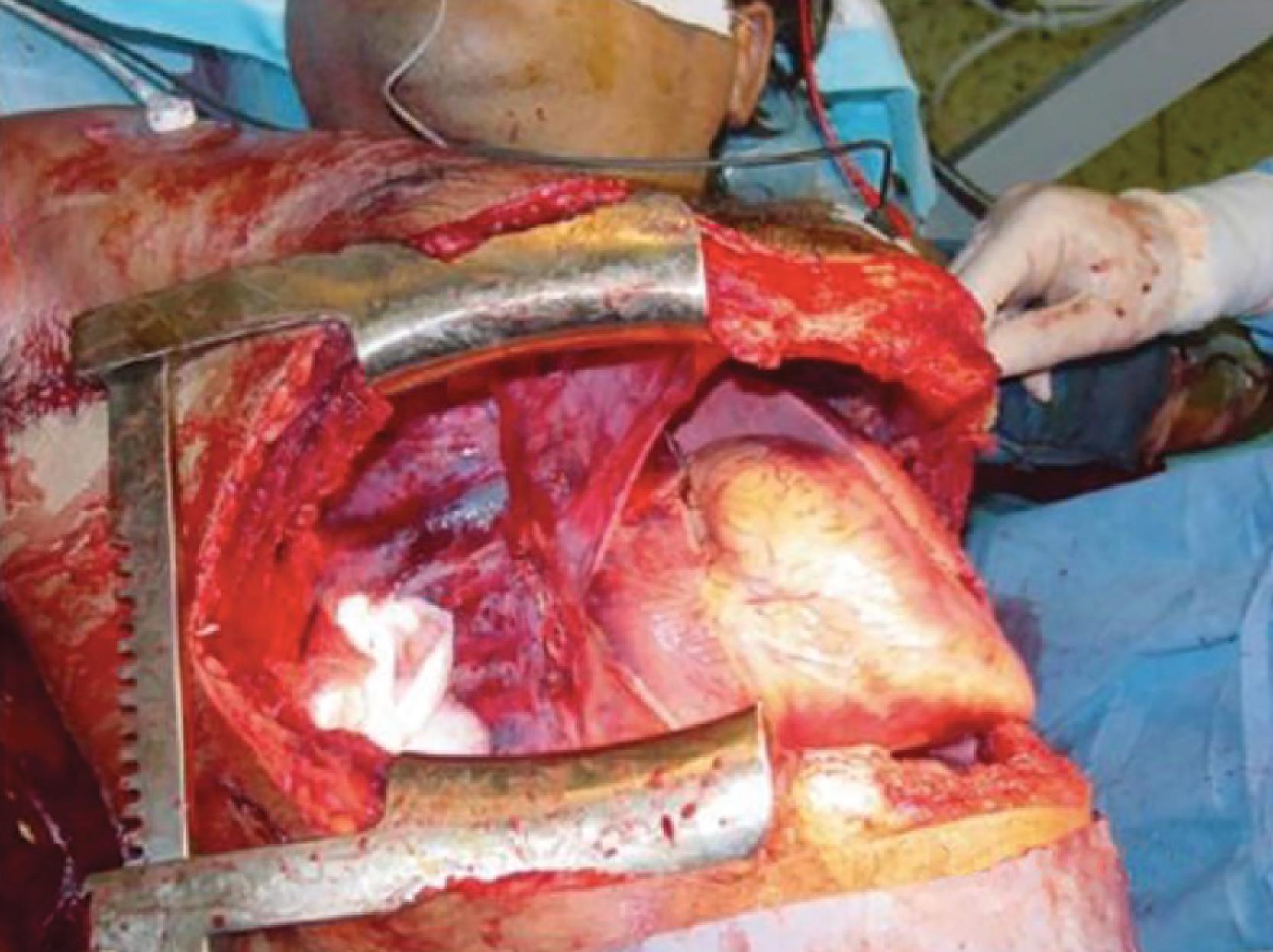 FIG. 5, Tractotomy.