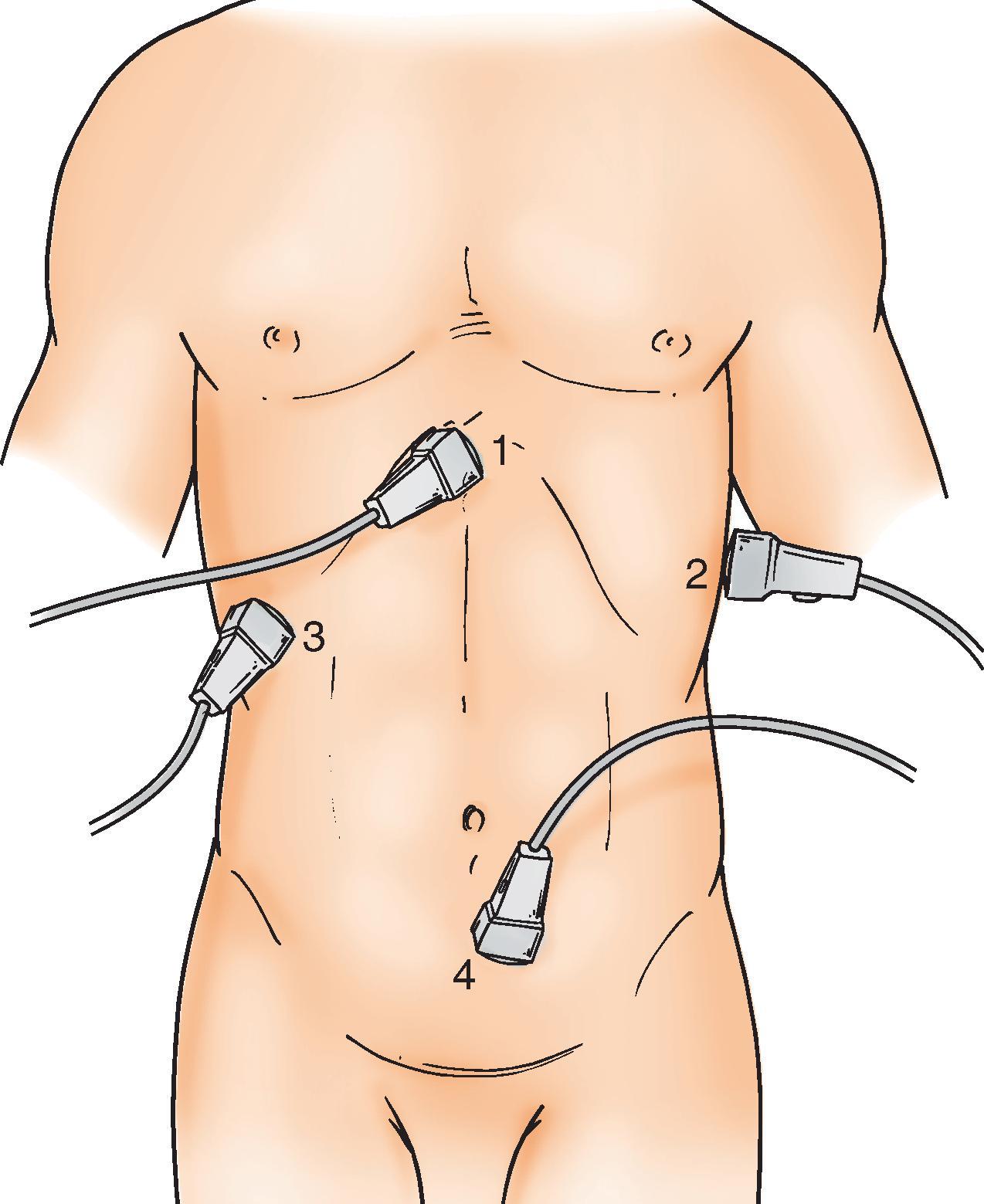 FIG. 1, Sonographic windows for (1) subxyphoid, (2) left subcostal, (3) right subcostal, and (4) suprapubic areas. Distension of the urinary bladder either before Foley catheter placement or by installation of 150 to 200 mL normal saline enhances sensitivity.