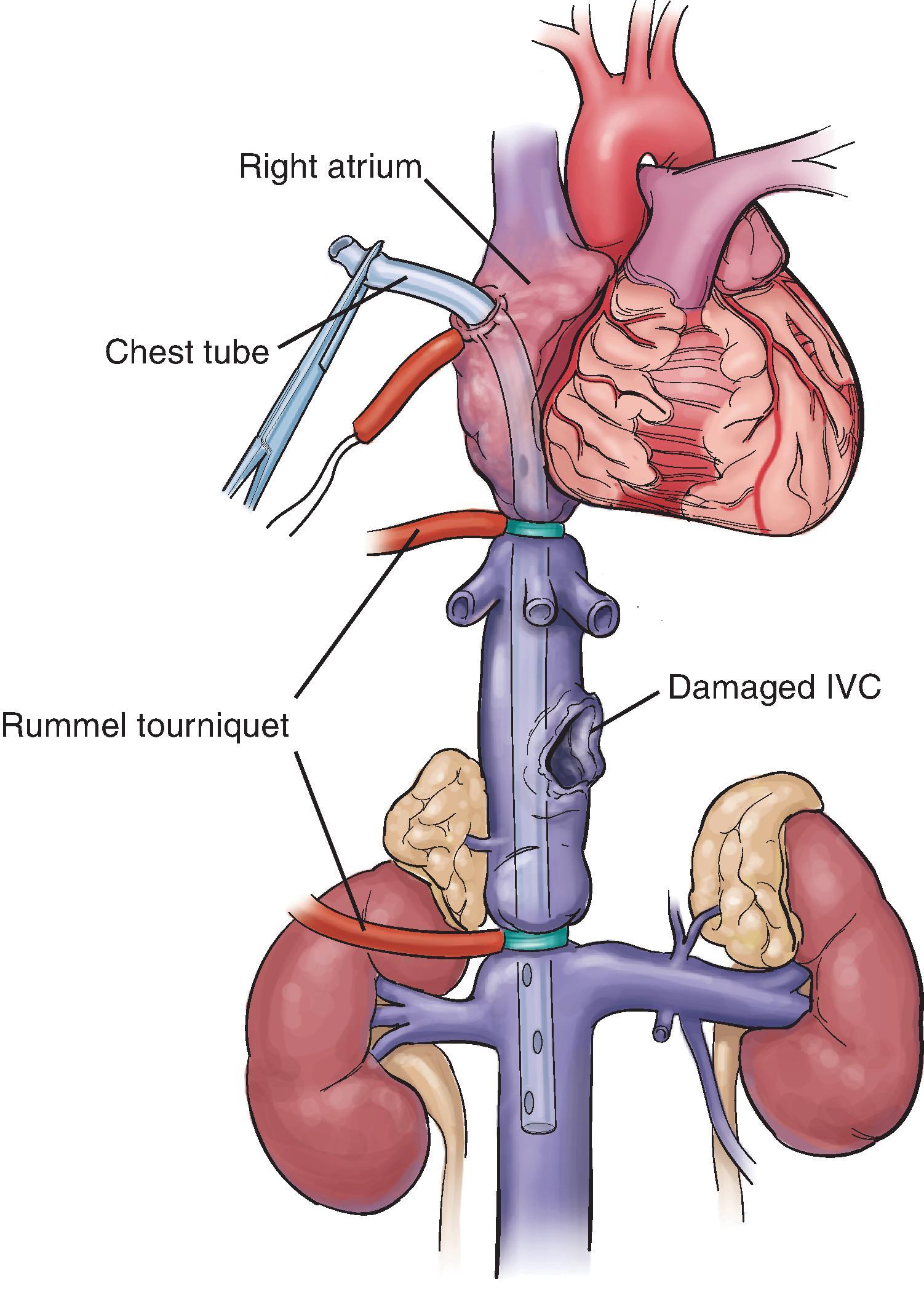 FIG. 4, After obtaining the necessary exposure (thoracotomy, mediasternotomy), an opening––along with a 2.0 Prolene pursestring suture––is created in the right atrial appendage to provide the access needed for insertion of the atriocaval shunt, which is usually a No. 36 chest tube. An extra hole must be made at the level of the right atrium. With the chest tube holes being outside of the umbilical tape occlusion, blood is directed from the lower half of the body and the kidney through the atriocaval shunt. IVC, Inferior vena cava.