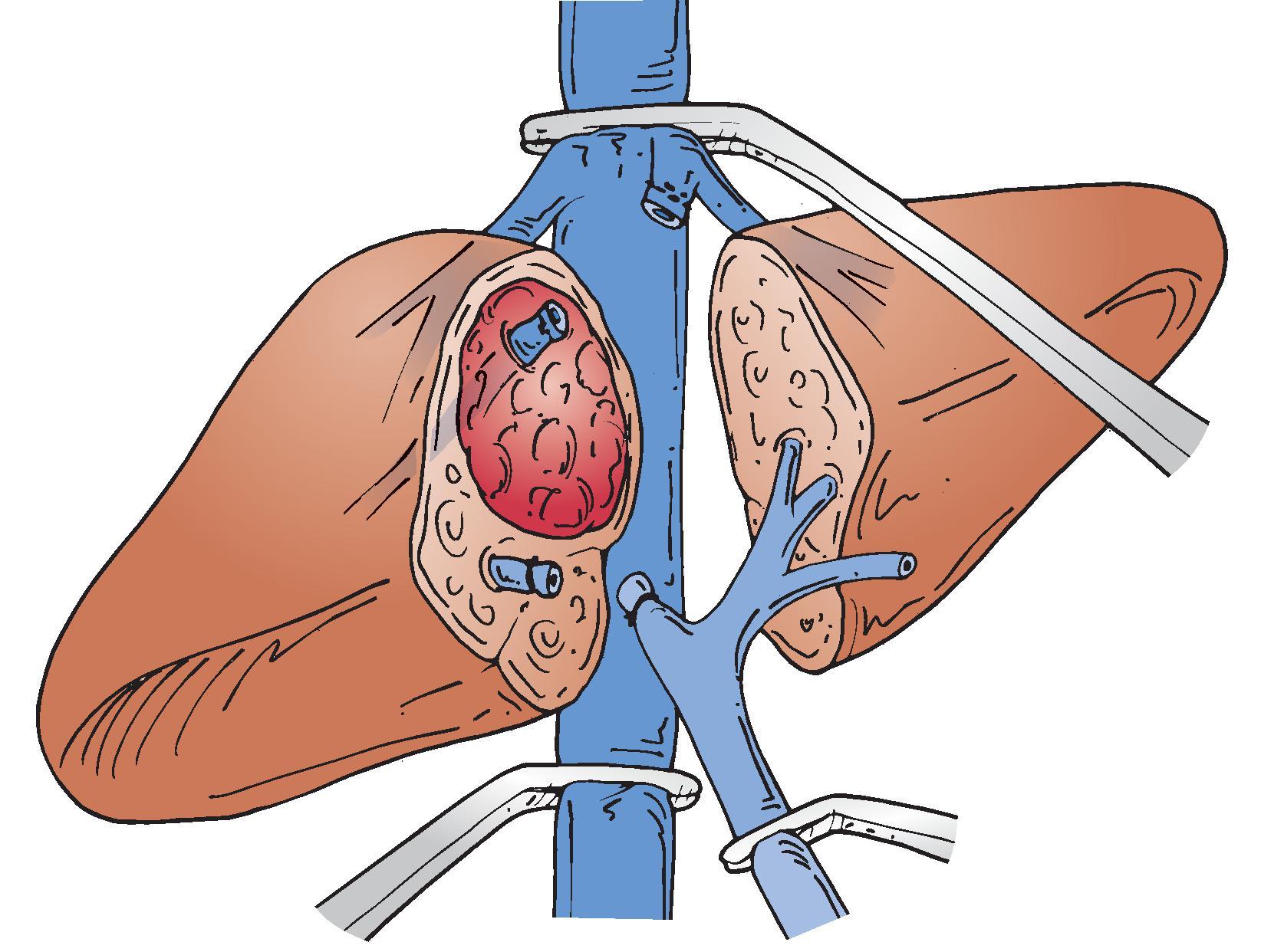 FIG. 5, The Heaney maneuver. Vascular isolation of the injured liver by applying vascular clamps to the suprahepatic and infrahepatic inferior vena cava, in addition to a Pringle maneuver.