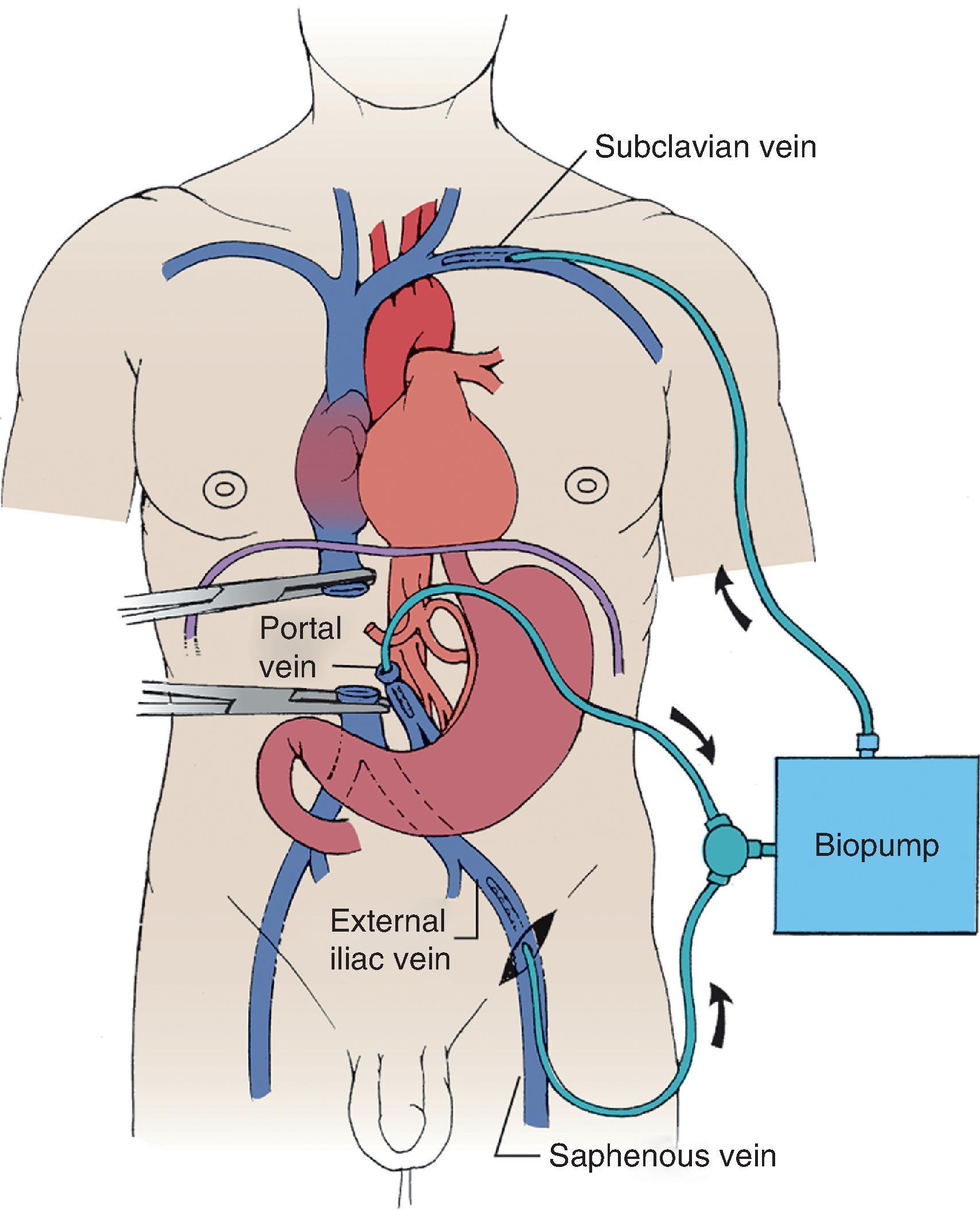 FIG. 6, The venovenous bypass requires cannulation of both the femoral vein and the axillary vein. A heparin-coated tubing connects the two cannulas. Flow is assisted by a centrifugal pump.