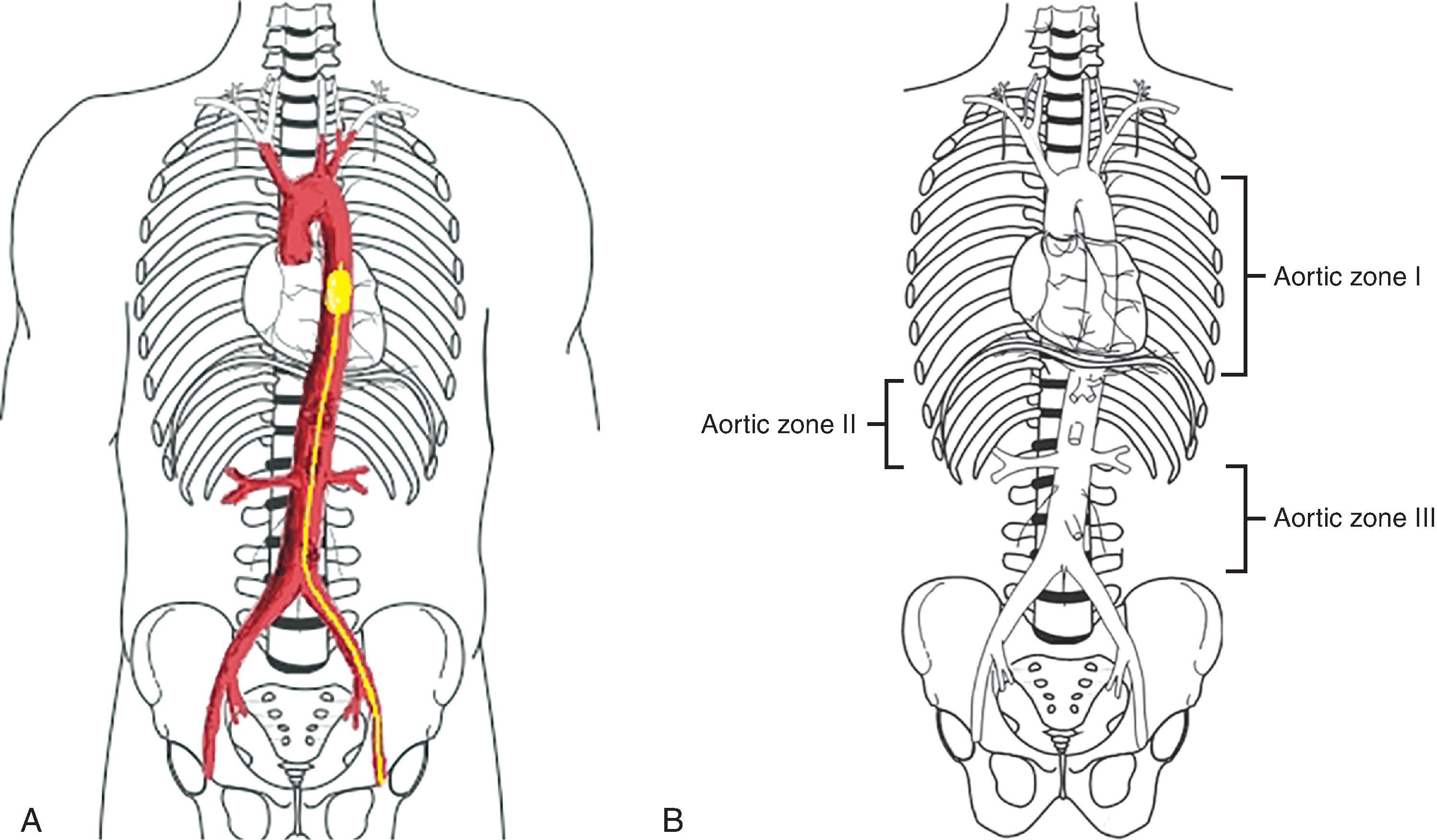 FIG. 7, (A) Aortic balloon occlusion device. (B) Aortic zones for positioning of resuscitative endovascular balloon occlusion of the aorta device. Zone I is between the subclavian artery and celiac artery, zone II is between the celiac artery and the lowest renal artery, and zone III is between the lowest renal artery and the aortic bifurcation.