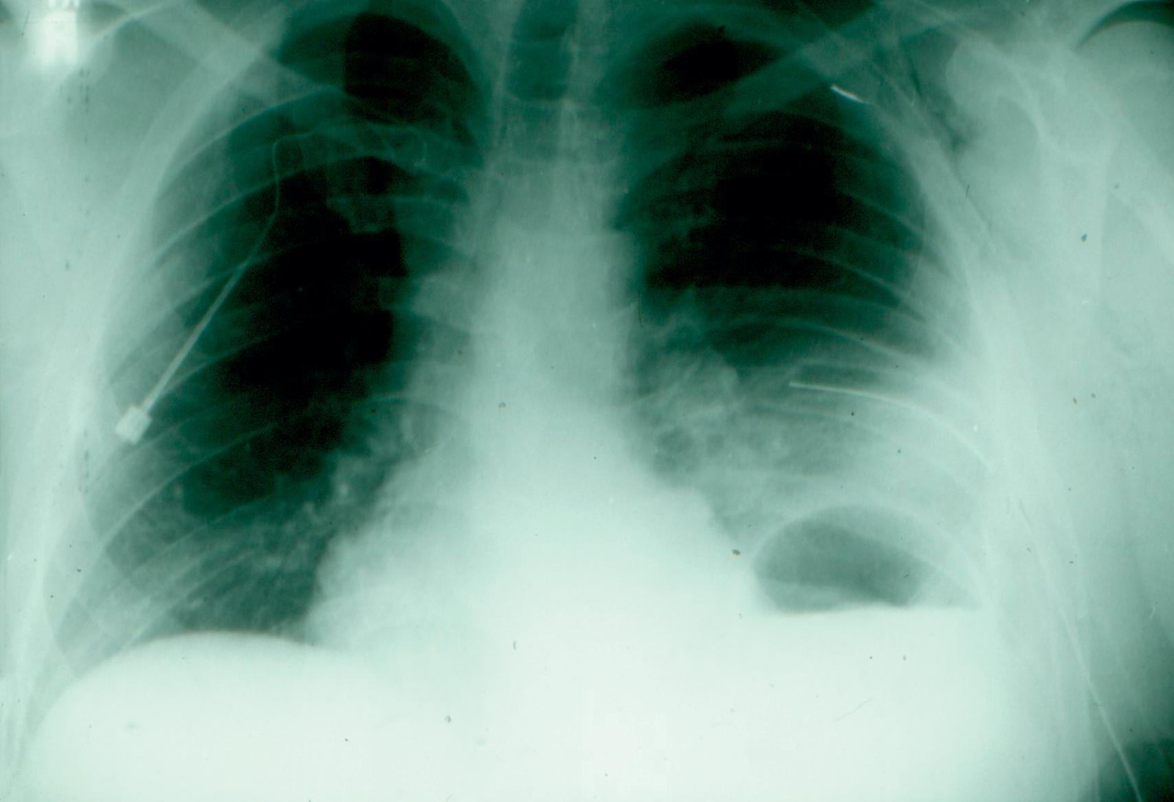 FIG. 1, This patient with a left thoracoabdominal gunshot wound had a 3-day delay before wounds to the left hemidiaphragm and stomach were diagnosed.