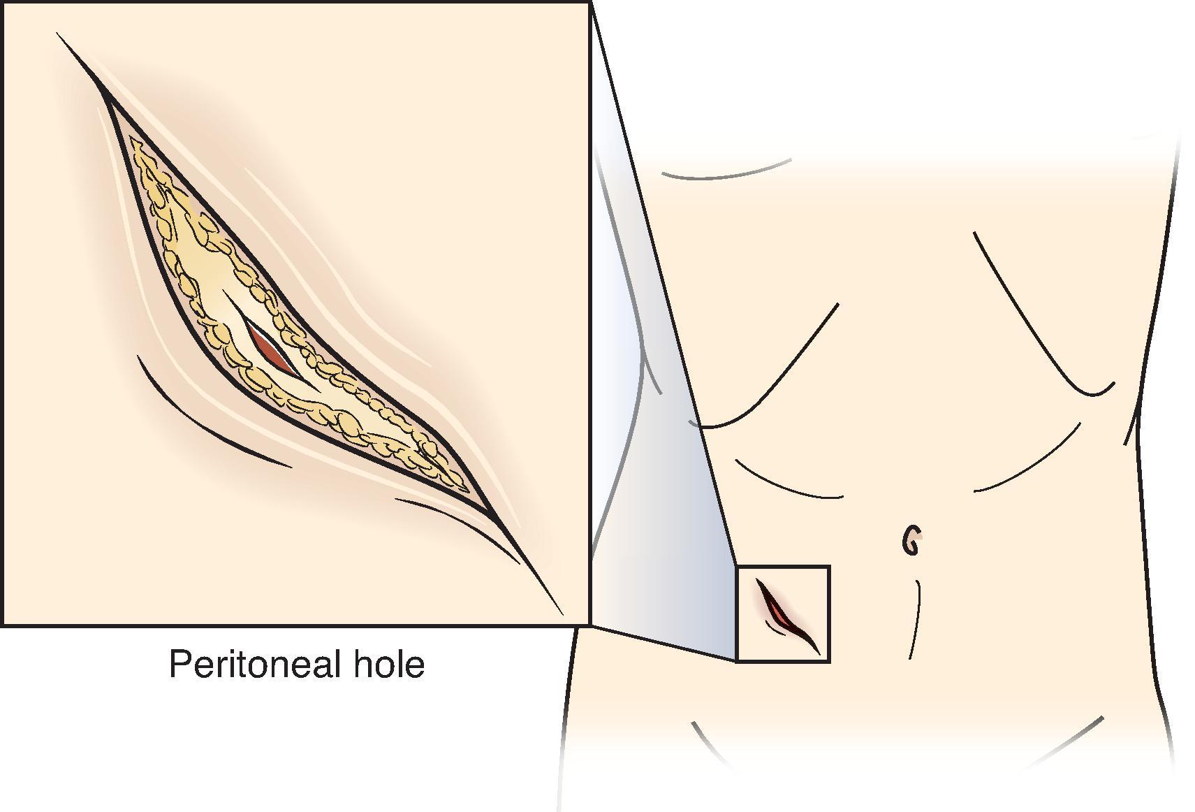 FIG. 2, Peritoneal perforation on a local wound exploration after a stab wound to the anterior abdominal wall mandates admission and serial physical examinations.