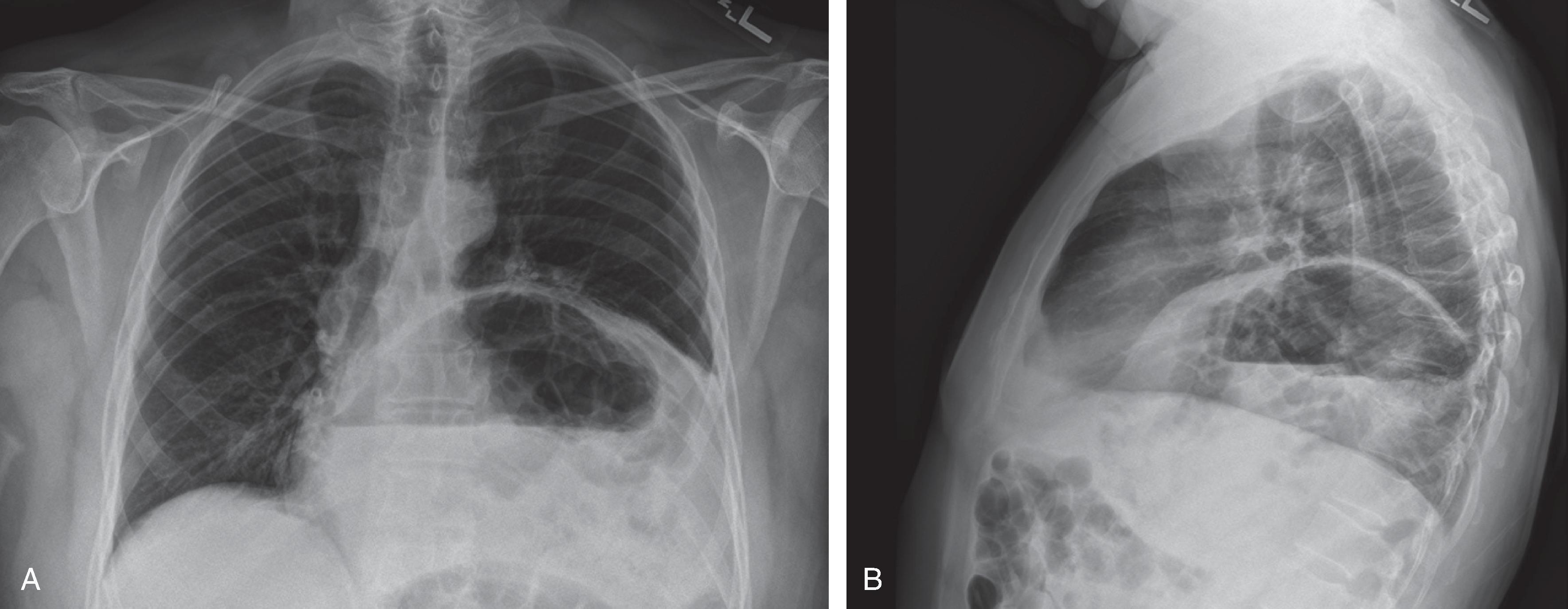 FIG. 2, Anteroposterior (A) and l ateral (B) chest x-rays showing traumatic diaphragmatic injury with herniation of the stomach into the left chest.