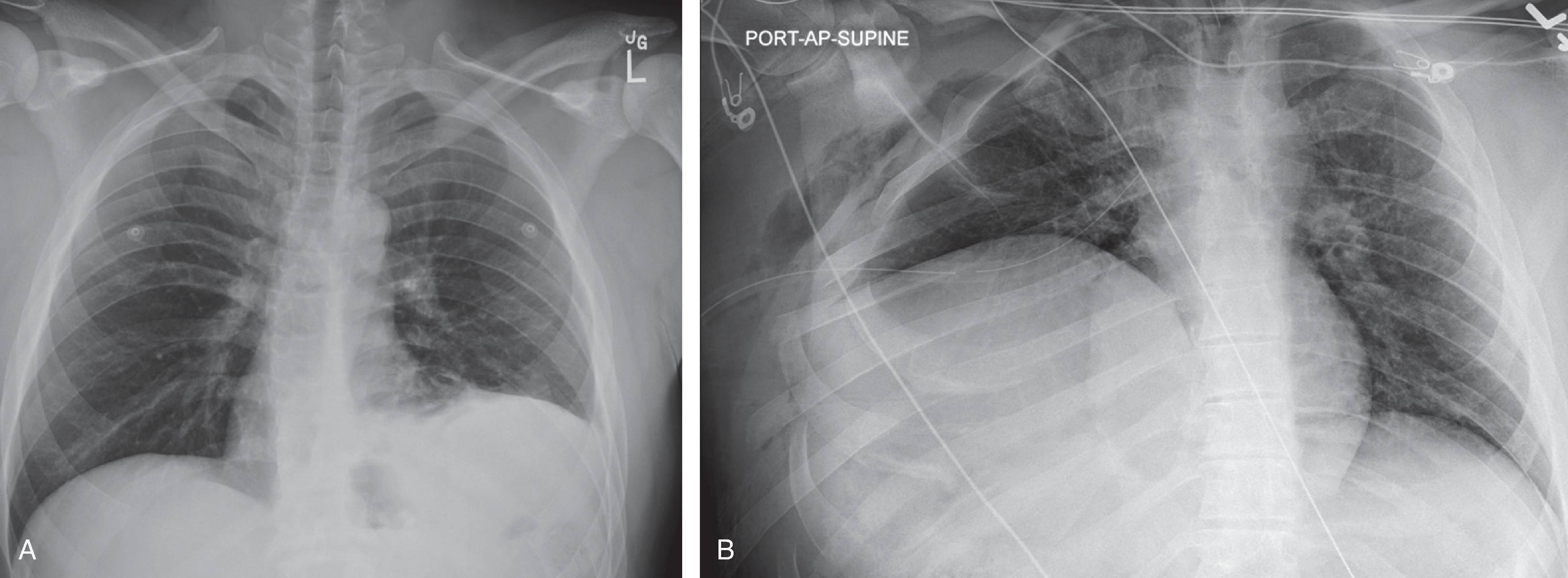 FIG. 3, (A) Chest x-ray of a patient with acute left-sided diaphragmatic injury. Elevation of the left hemidiaphragm with blunting of the costophrenic angle is noted. (B) Acute right-sided diaphragmatic injuries. In addition to significantly elevated right hemidiaphragm, there are multiple findings suggestive of associated thoracic injuries (subcutaneous emphysema, multiple rib fractures).