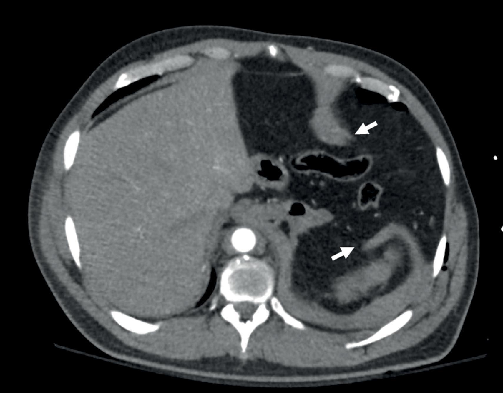 FIG. 4, Dangling diaphragm sign. A large defect in the left diaphragm with defect edges retracted and curled (arrows).