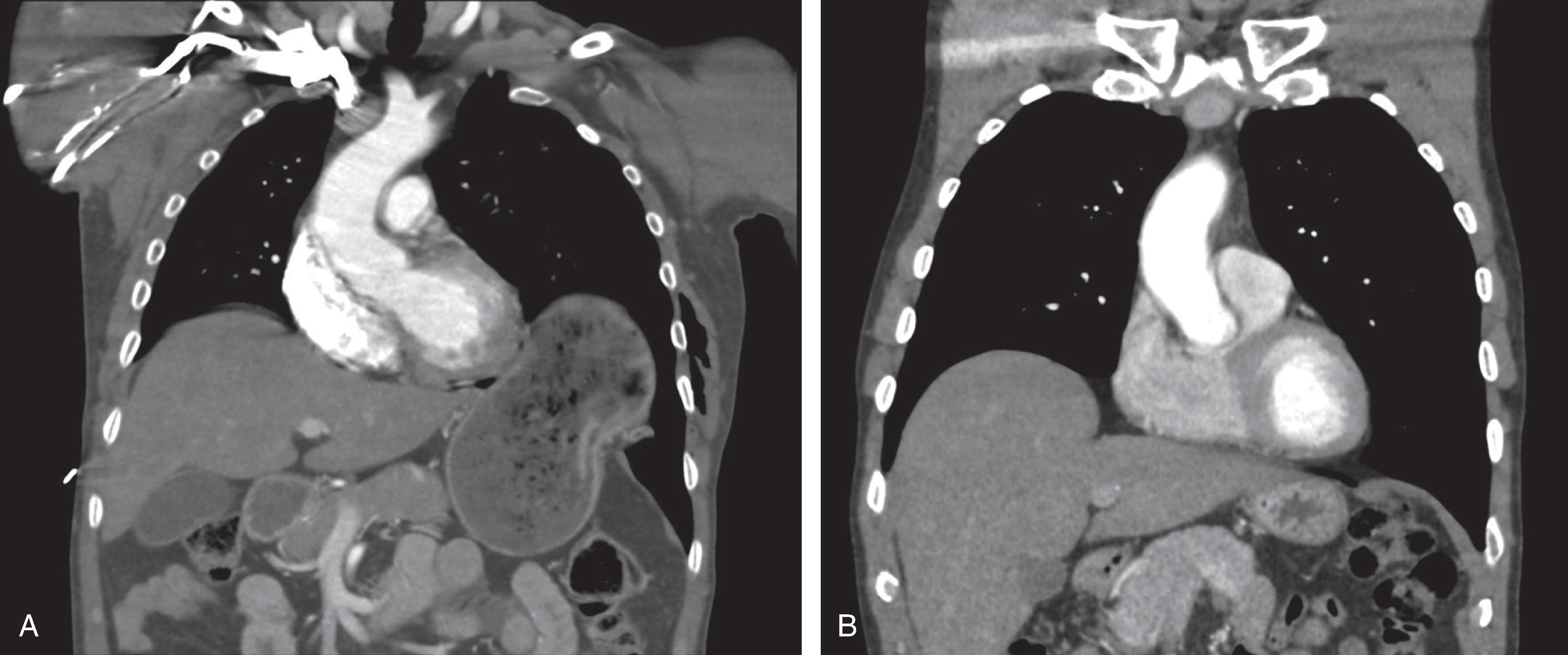 FIG. 5, (A) Collar sign. A waistlike constriction of the stomach herniated through a defect in the left hemidiaphragm is seen on a coronal reconstruction image. (B) Hump sign. Focal bulging of the right hemidiaphragm due to herniation of the liver parenchyma.