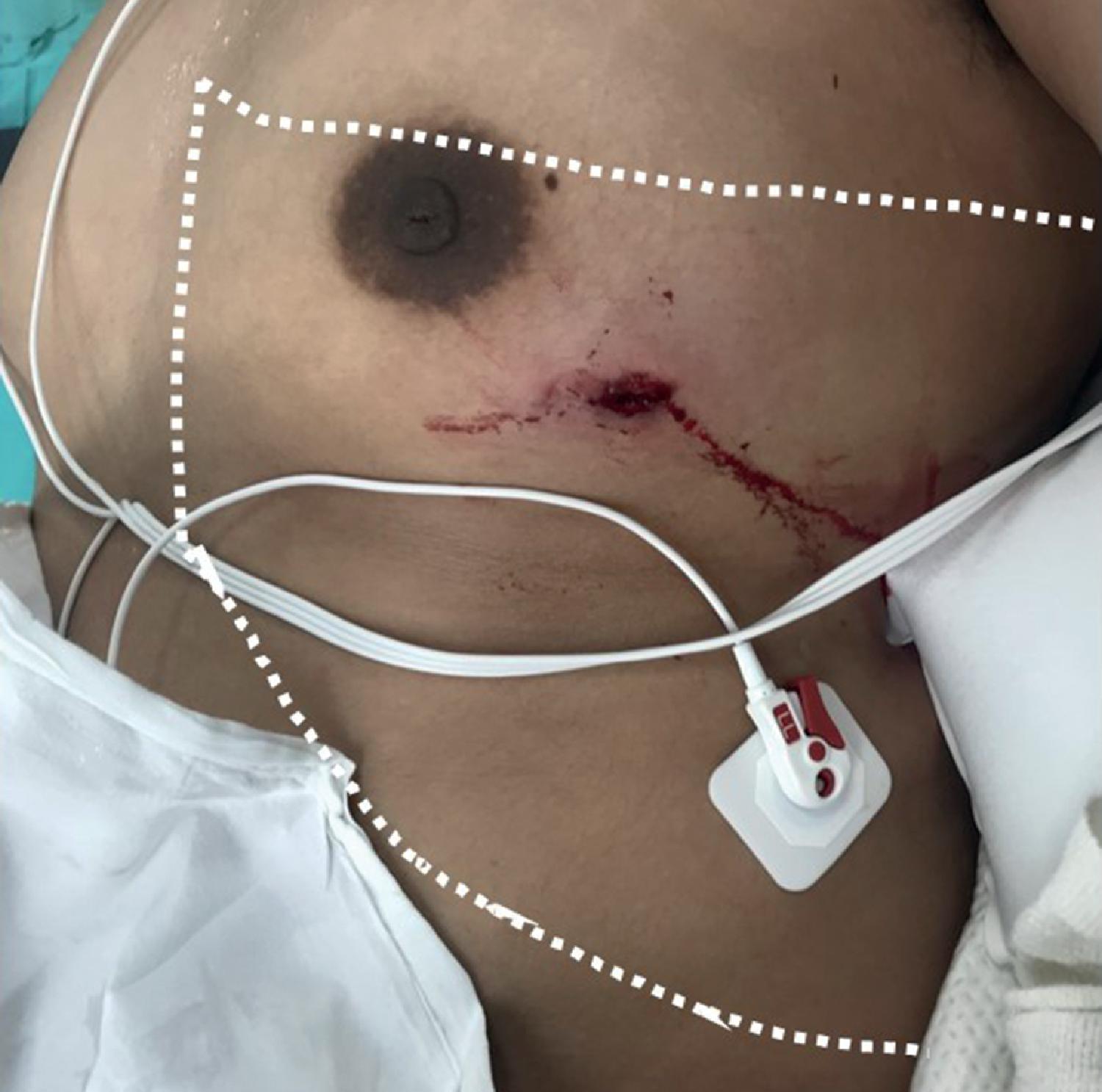 FIG. 6, Penetrating wounds to the left thoracoabdominal area bordered by the nipple to scapula tip superiorly and the costal margin inferiorly are high risk and should be evaluated for underlying diaphragmatic injuries.