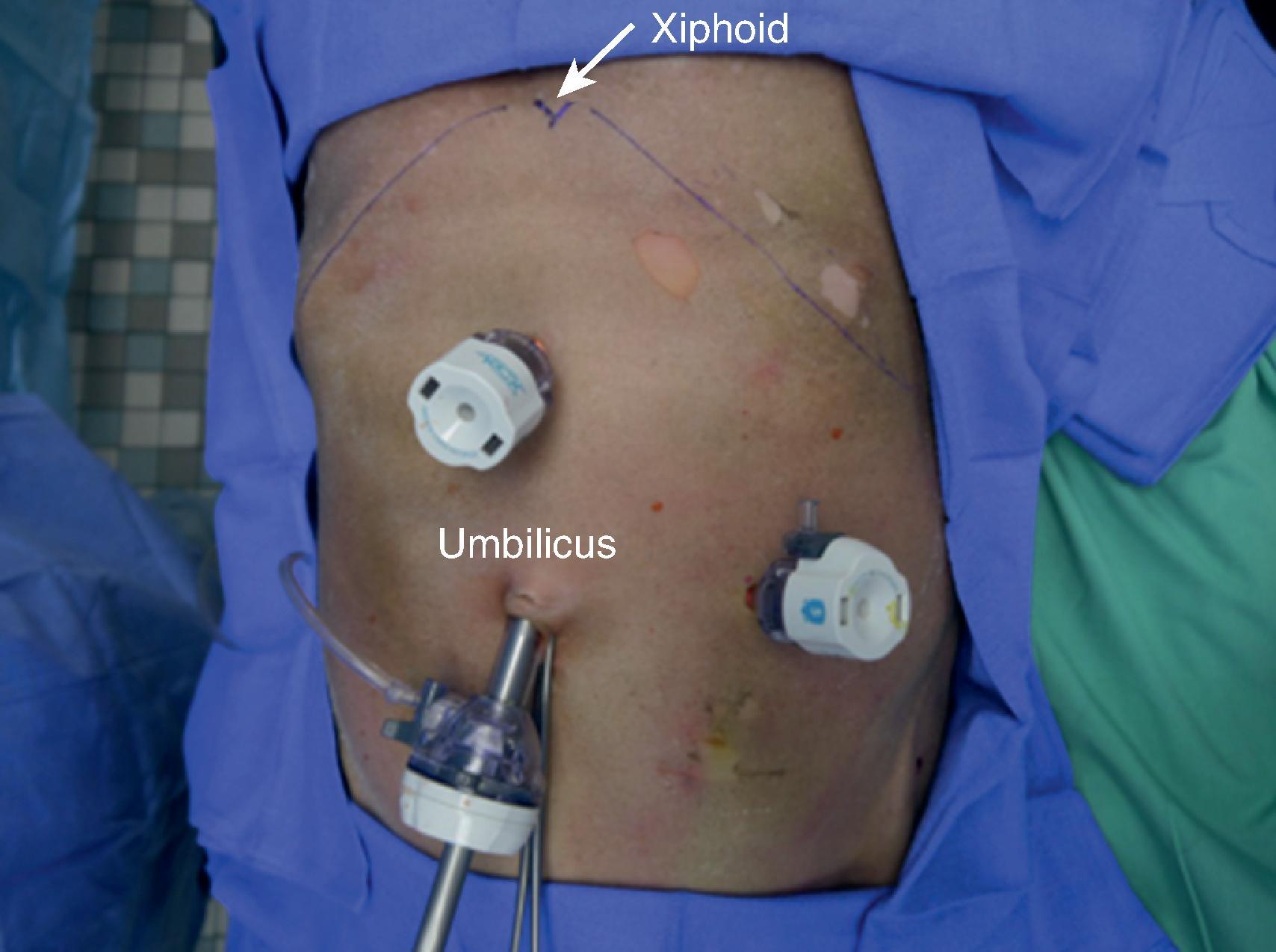 FIG. 7, Port placement for diagnostic laparoscopy for left-sided thoracoabdominal penetrating injuries.