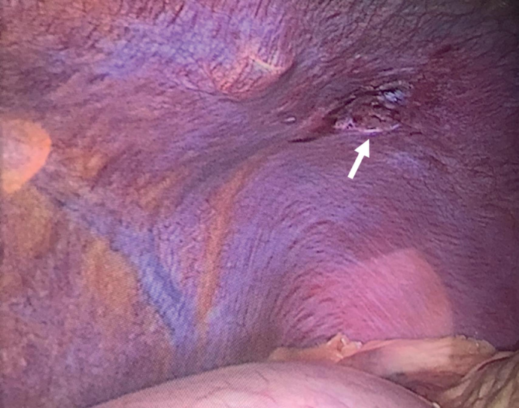 FIG. 8, A small diaphragmatic defect seen during diagnostic laparoscopy following left-sided thoracoabdominal gunshot wound (arrow).