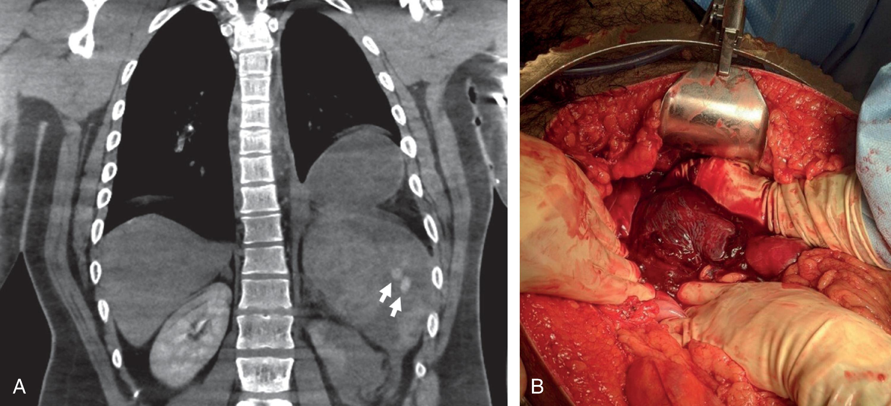 FIG. 9, (A) CT scan shows left-sided diaphragm injury associated with high-grade splenic injury with active contrast extravasation (arrows). (B) Intraoperative view of the herniated spleen after reduction. Splenectomy was required for active hemorrhage.