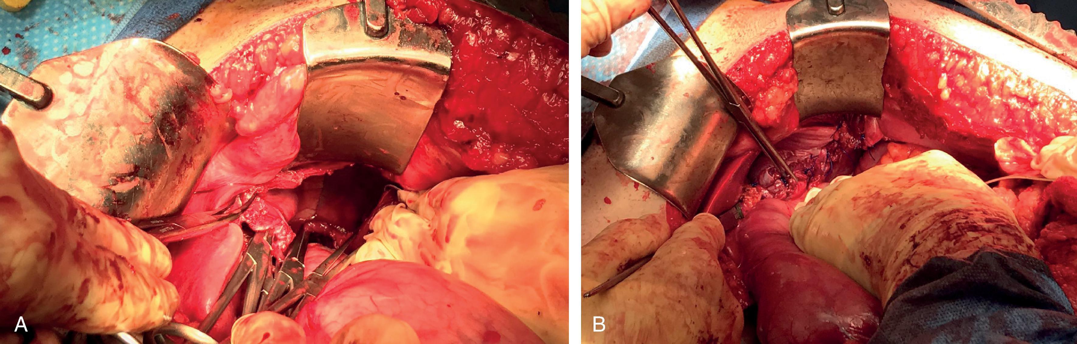 FIG. 10, (A) Exposure of the entire diaphragm defect and assessment of associated intrathoracic injuries through the defect should be performed before surgical repair. (B) Primary repair of the large diaphragm defect was performed with interrupted sutures.