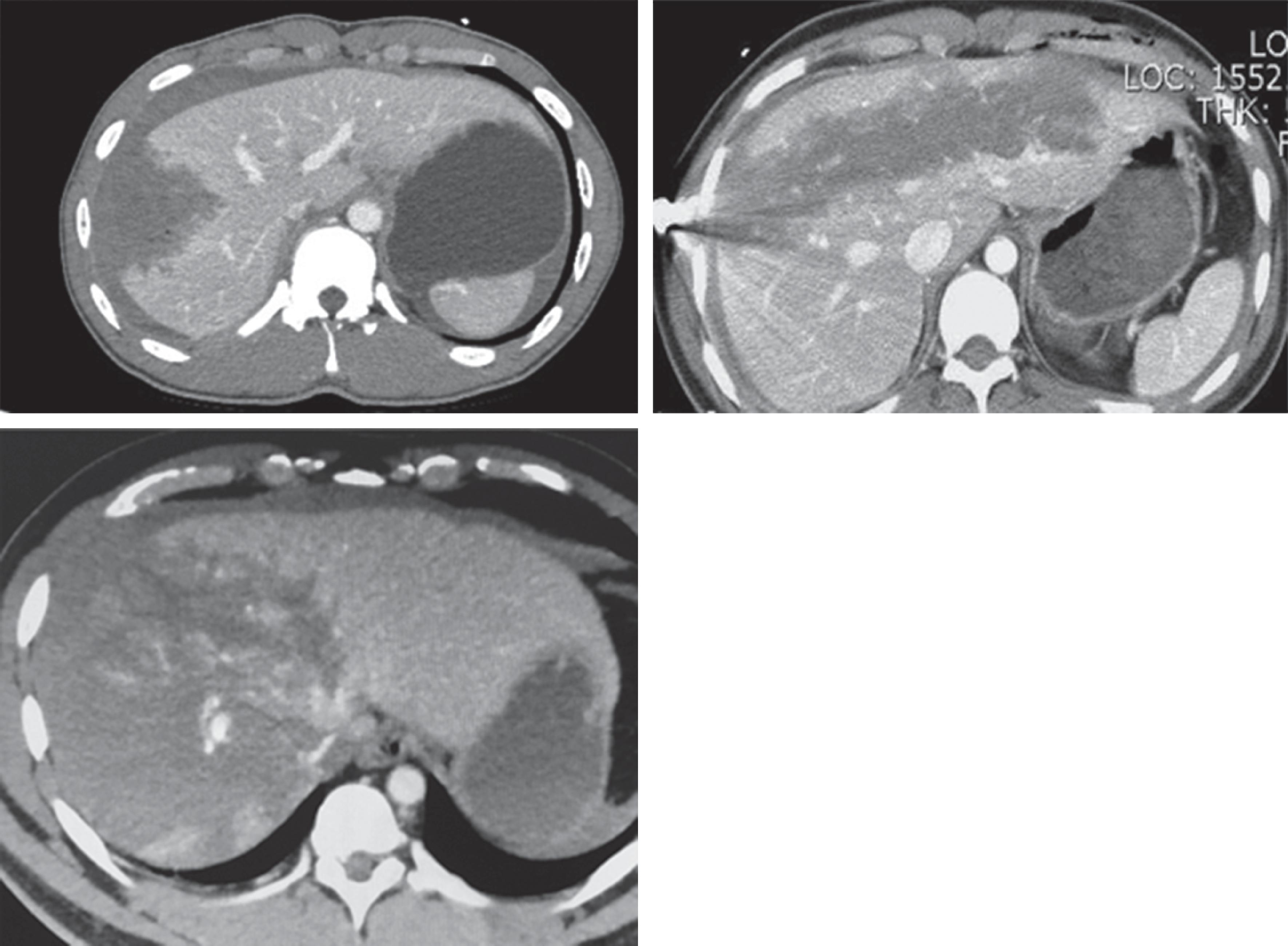 FIG. 1, CT images of liver injury.