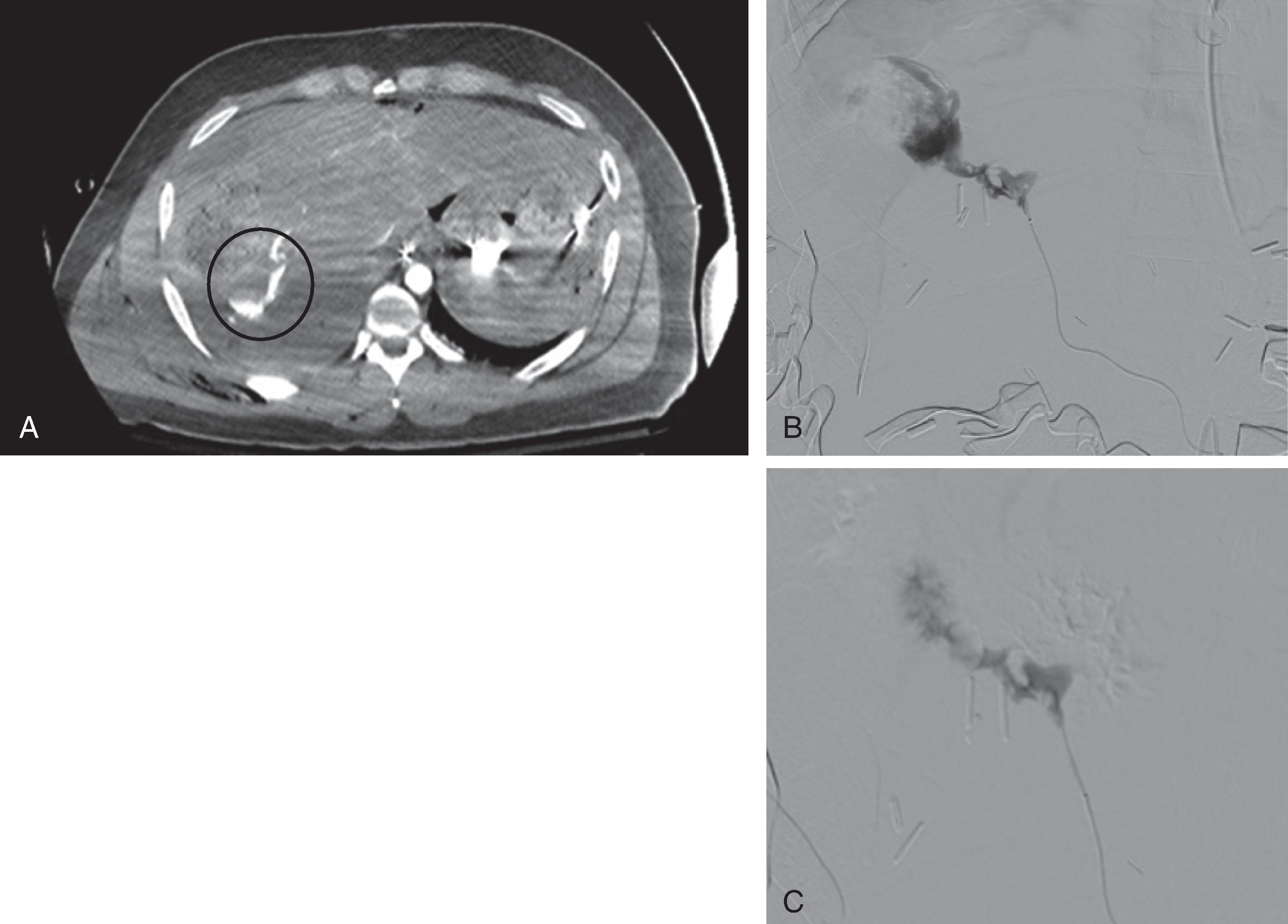 FIG. 2, (A) CT scan showing active extravasation of contrast ( circle ). (B) Angiography showing a large amount of active extravasation. (C) Postembolization shows resolution of contrast extravasation.