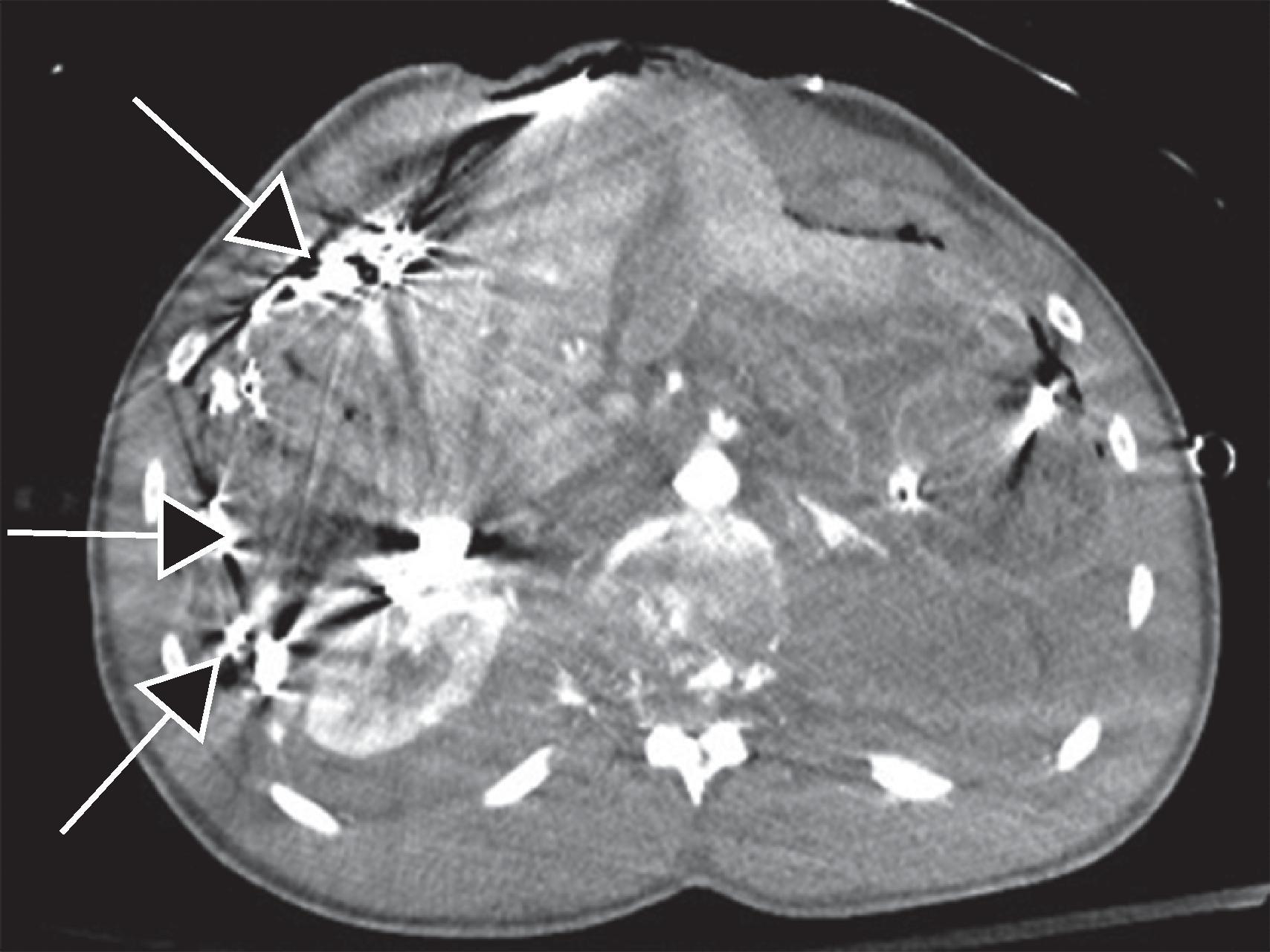 FIG. 3, CT scan of anterior and posterior hepatic packing (arrows) in grade V liver injury.