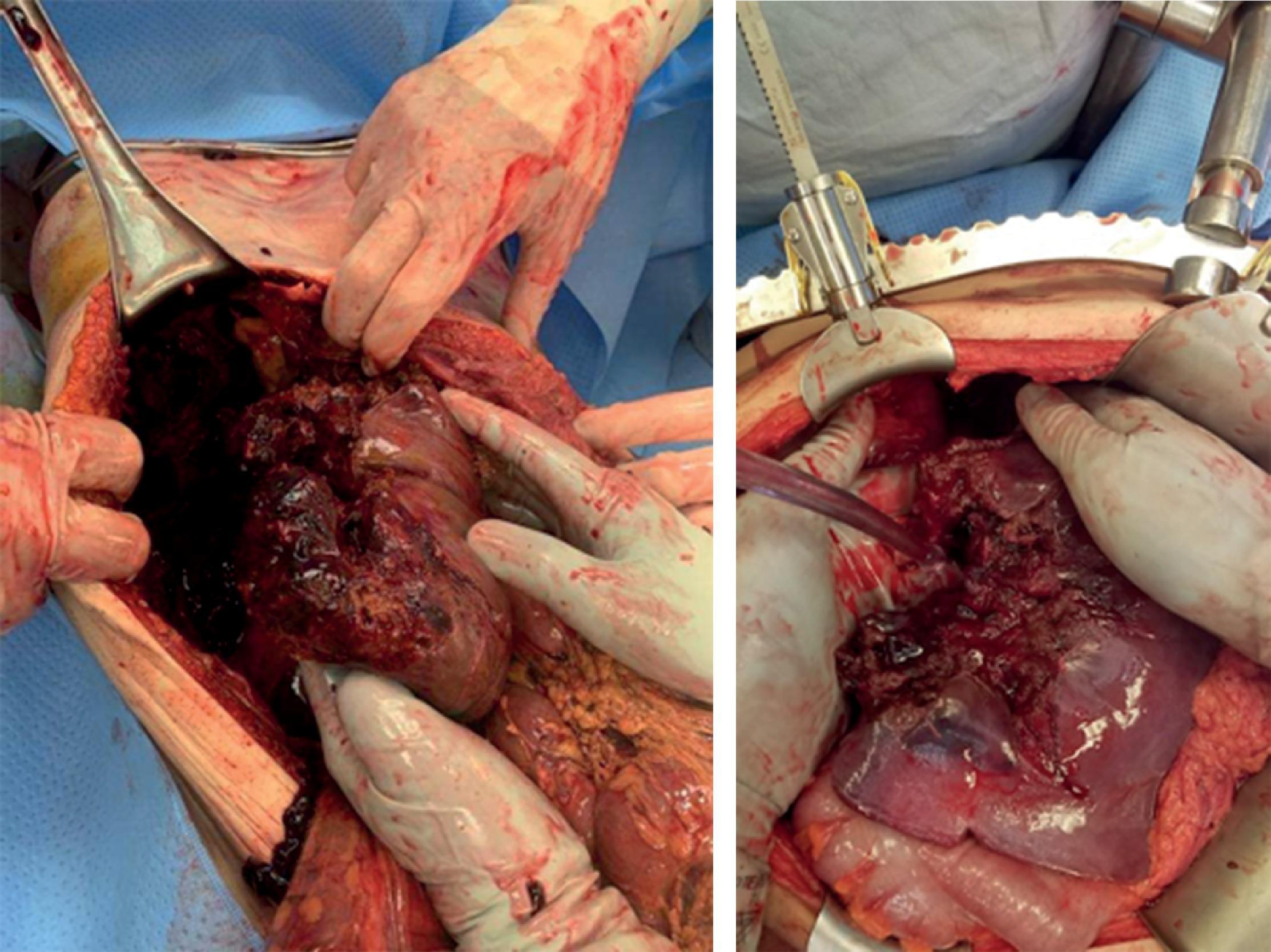 FIG. 4, Intraoperative images showing significant parenchymal destruction.