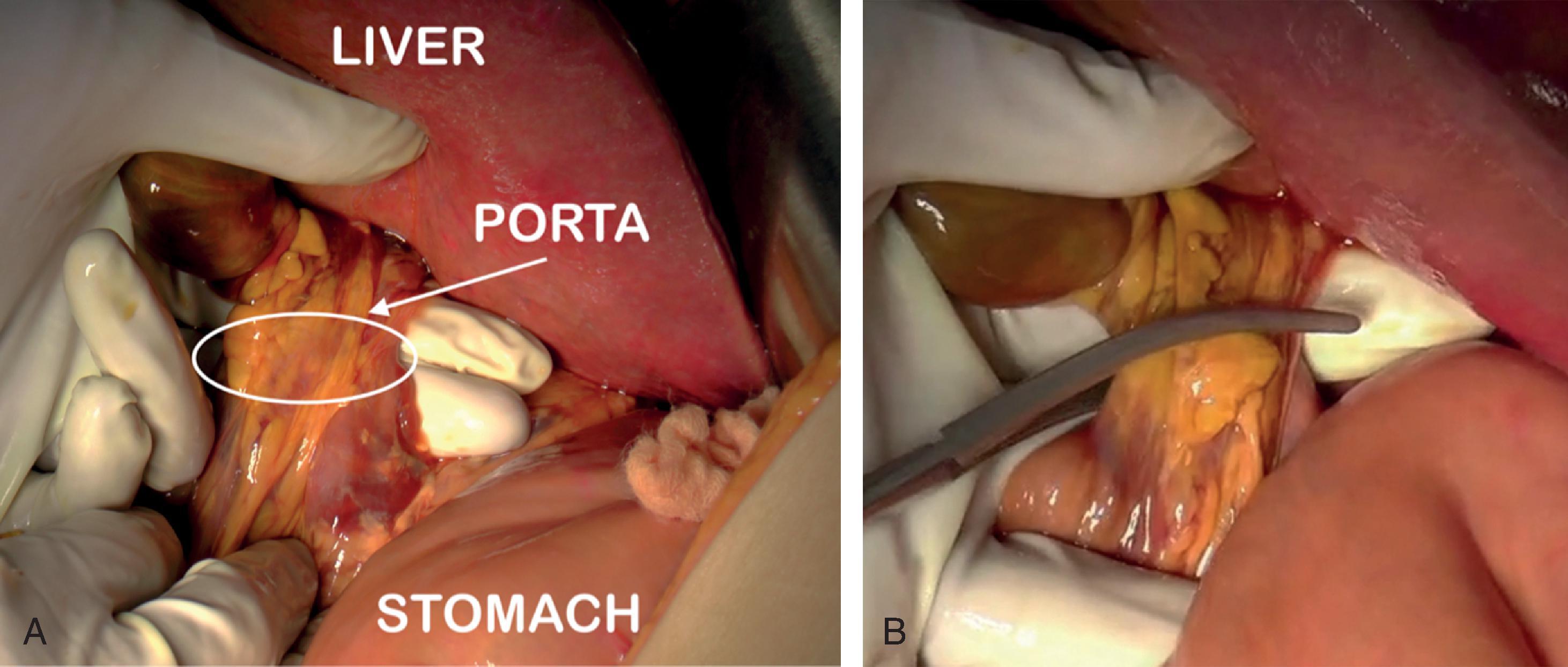 FIG. 6, Intraoperative images showing Pringle maneuver with a vascular clamp.