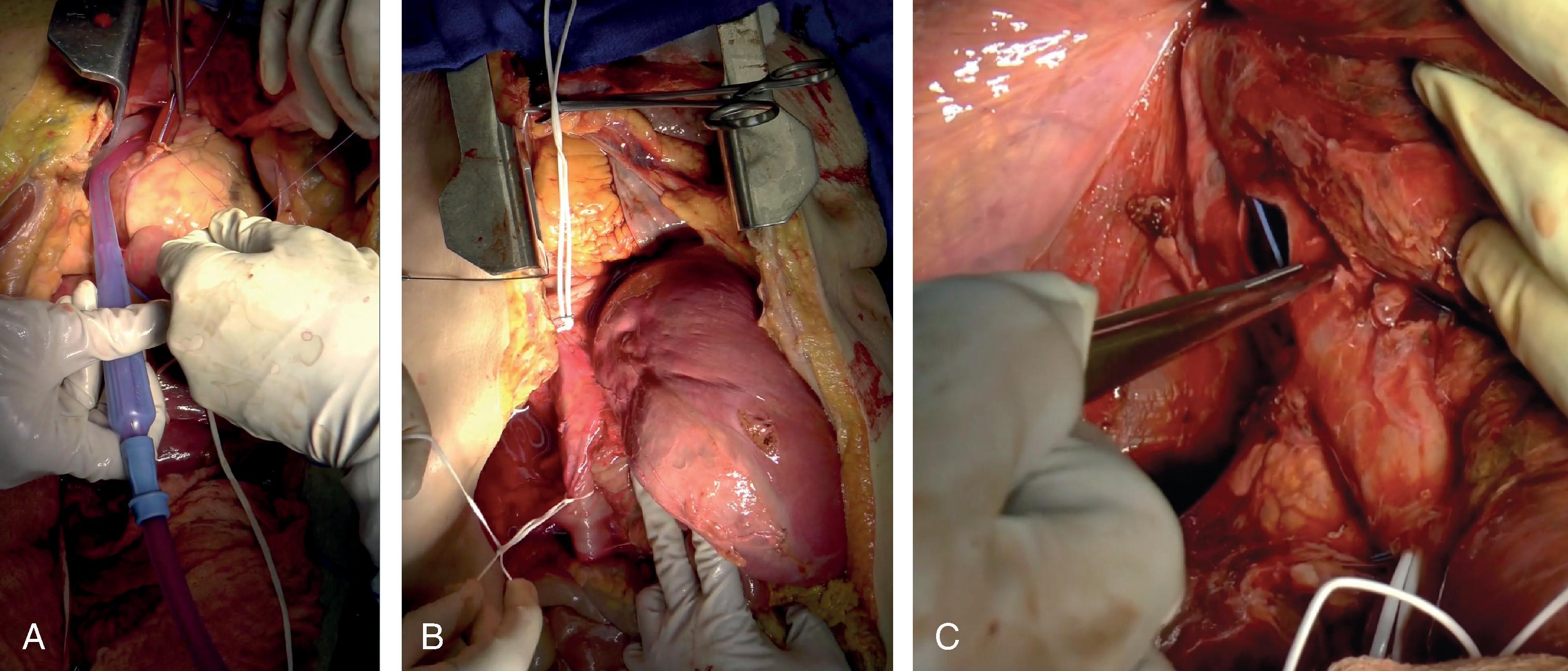 FIG. 7, Atriocaval shunt. (A) A chest tube is placed in right atrial appendage and secured with a purse-string suture. (B) The chest tube is secured at the suprahepatic and infrahepatic inferior vena cava. (C) Isolation of the retrohepatic injury.