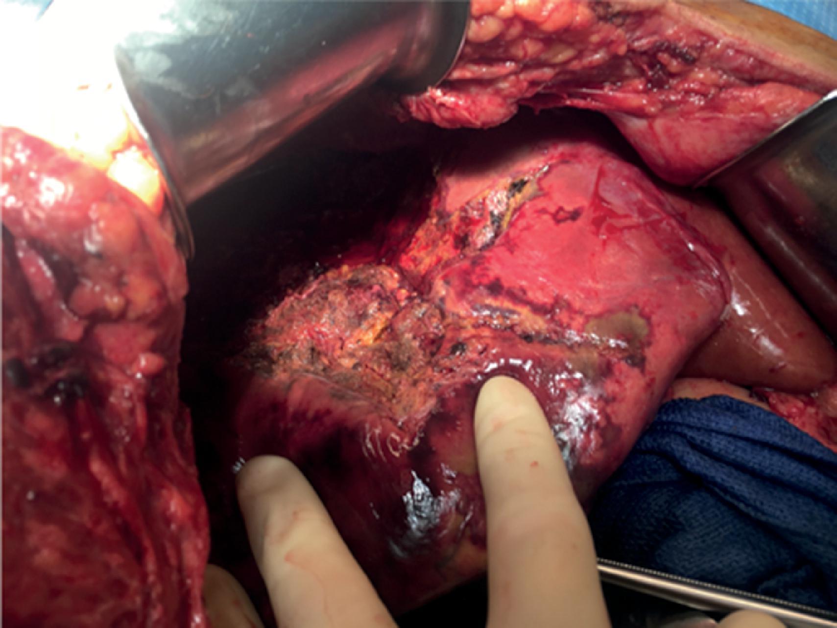 FIG. 8, Hepatic necrosis seen after angioembolization.