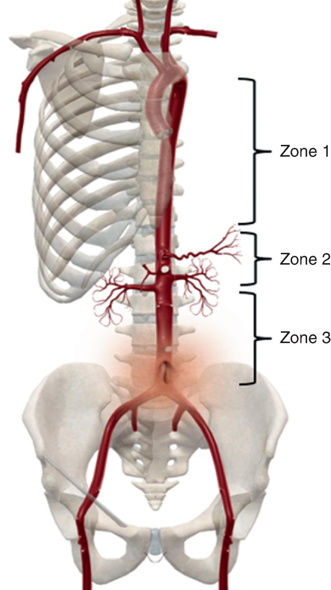 FIG. 4, Zones of the aorta.