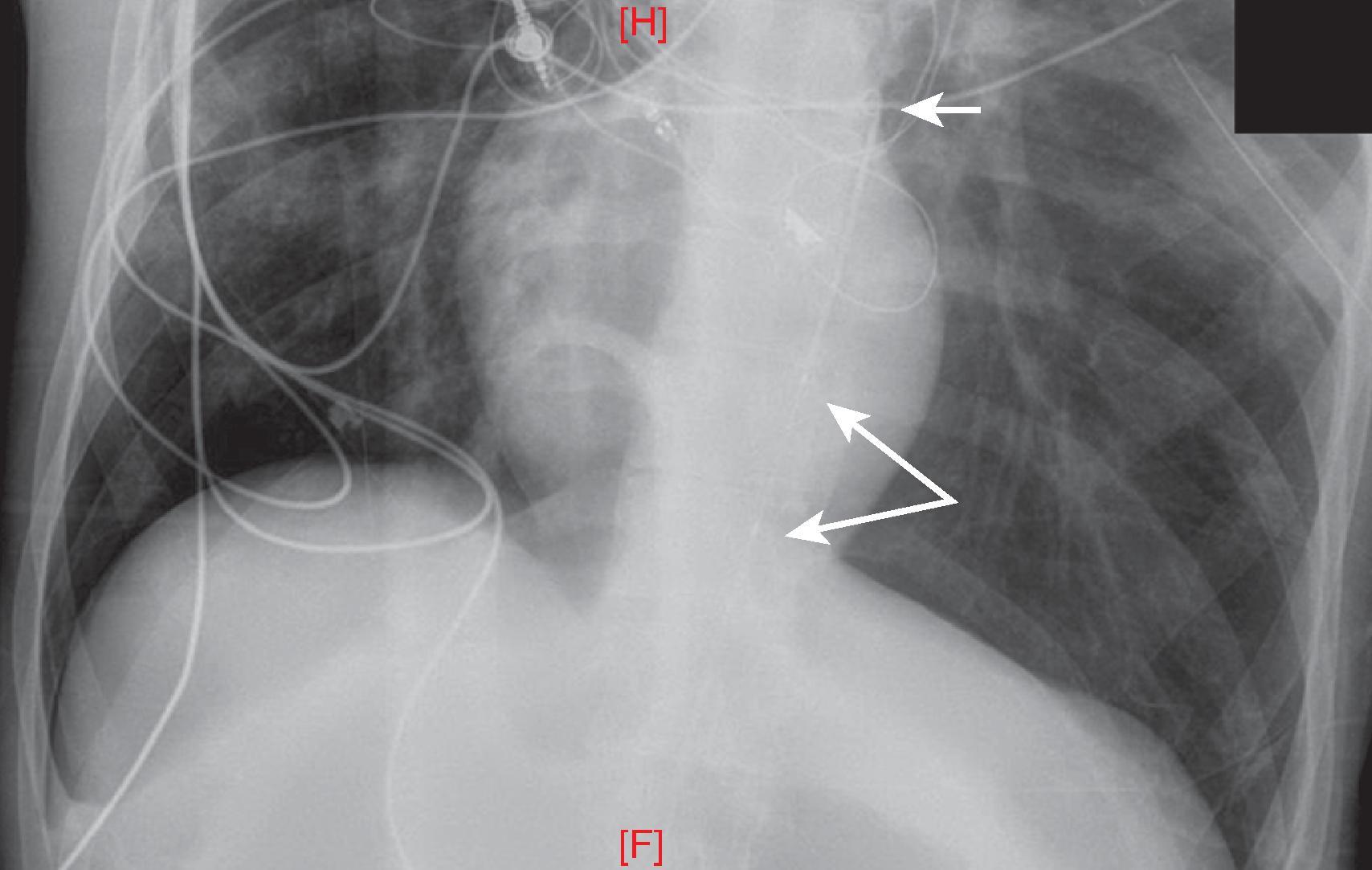 FIG. 5, Chest radiograph confirming REBOA placement before inflation.