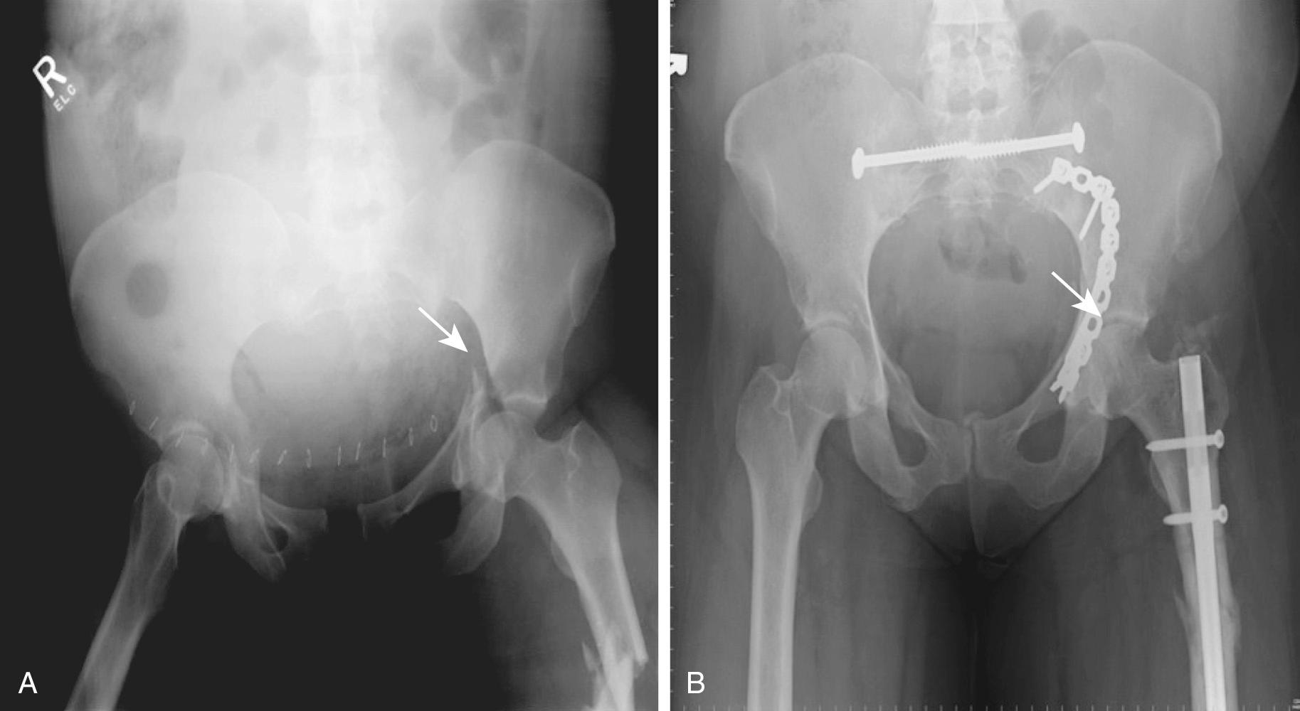 Fig. 32.1, The arrow points to a pelvic fracture before (A) and after (B) fixation in a pregnancy in the late third trimester that resulted in fetal death.