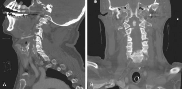 FIGURE 20-1, Sagittal ( A ) and coronal ( B ) computed tomography (CT) images showing facet diastasis at C3-C4 on the left, in a patient who was later diagnosed with a vertebral artery injury on CT angiography.