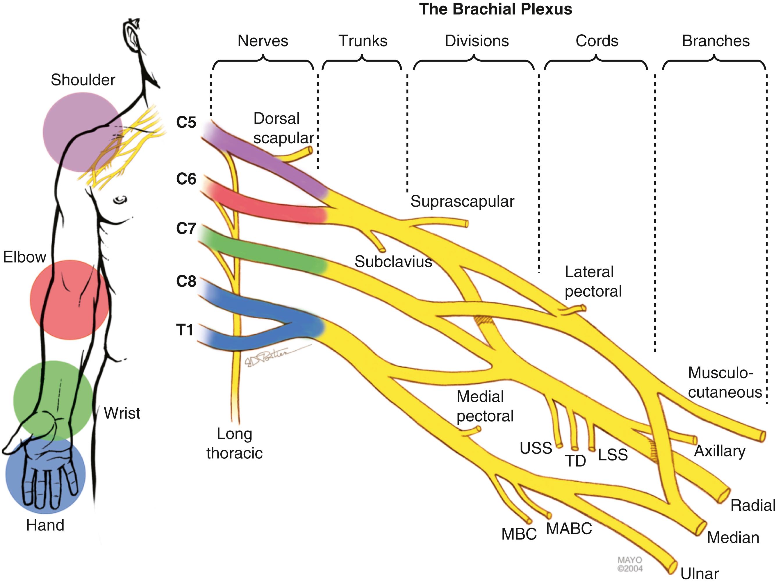 Fig. 34.1, Anatomy of the brachial plexus. Localization of brachial plexus lesions is dependent on detailed understanding of brachial plexus anatomy. This illustration is reviewed with patients at the time of their initial evaluation. LSS, Lower subscapular nerve; MABC, medial antebrachial cutaneous nerve; MBC, medial brachial cutaneous nerve; TD, thoracodorsal nerve; USS, upper subscapular nerve.