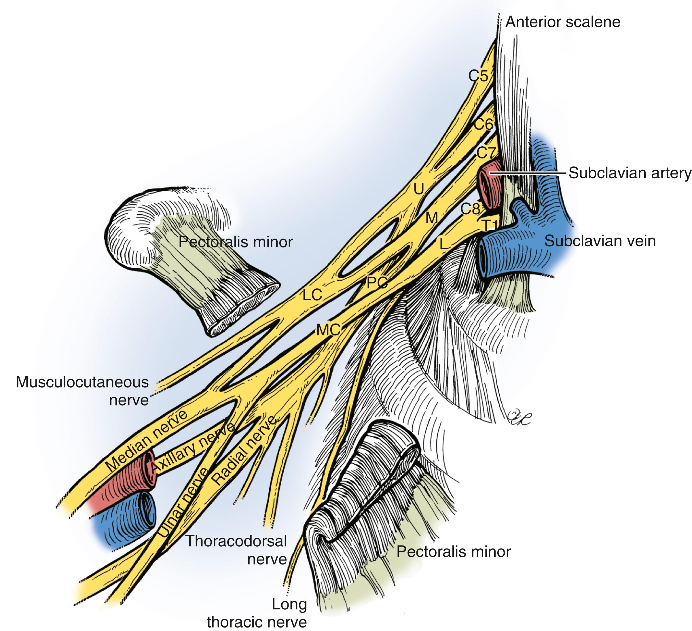 Fig. 34.11, Exposure of the infraclavicular brachial plexus is often done in conjunction with exploration of the supraclavicular brachial plexus. L, Lower trunk; LC, lateral cord; M, middle trunk; MC, medial cord; PC, posterior cord; U, upper trunk.