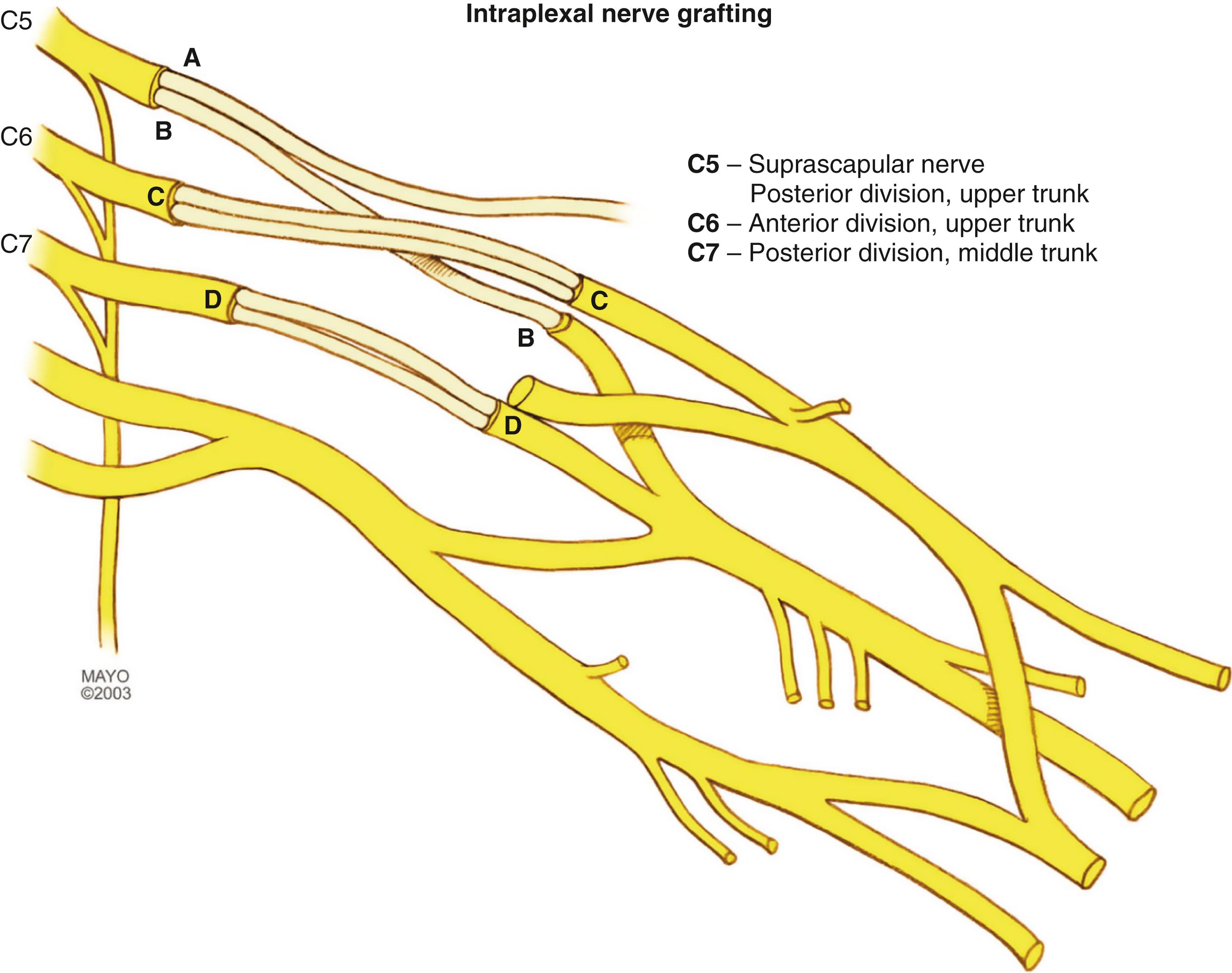 Fig. 34.13, Anatomic reconstruction of the brachial plexus is done whenever possible with intraplexal nerve grafts: C5 to shoulder targets, C6 to elbow flexors, and C7 to extensor muscles. A, Suprascapular nerve; B, posterior division, upper trunk; C, anterior division, upper trunk; D, posterior division, middle trunk.