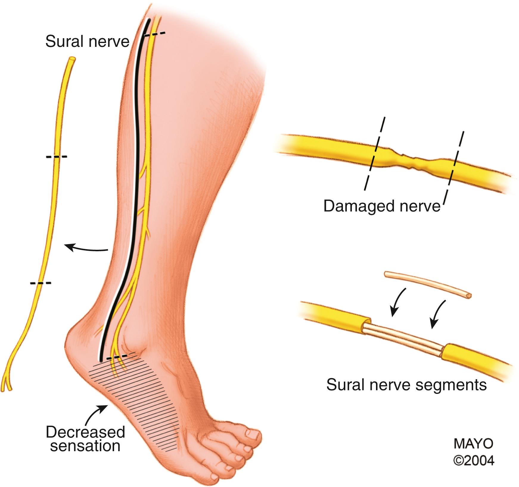 Fig. 34.14, The sural nerve is a commonly used donor for interposition nerve grafting of postganglionic lesions. This illustration is reviewed with patients to discuss the incision, technique, and morbidity (expected sensory loss and potential for neuropathic pain in the dorsolateral aspect of the foot).