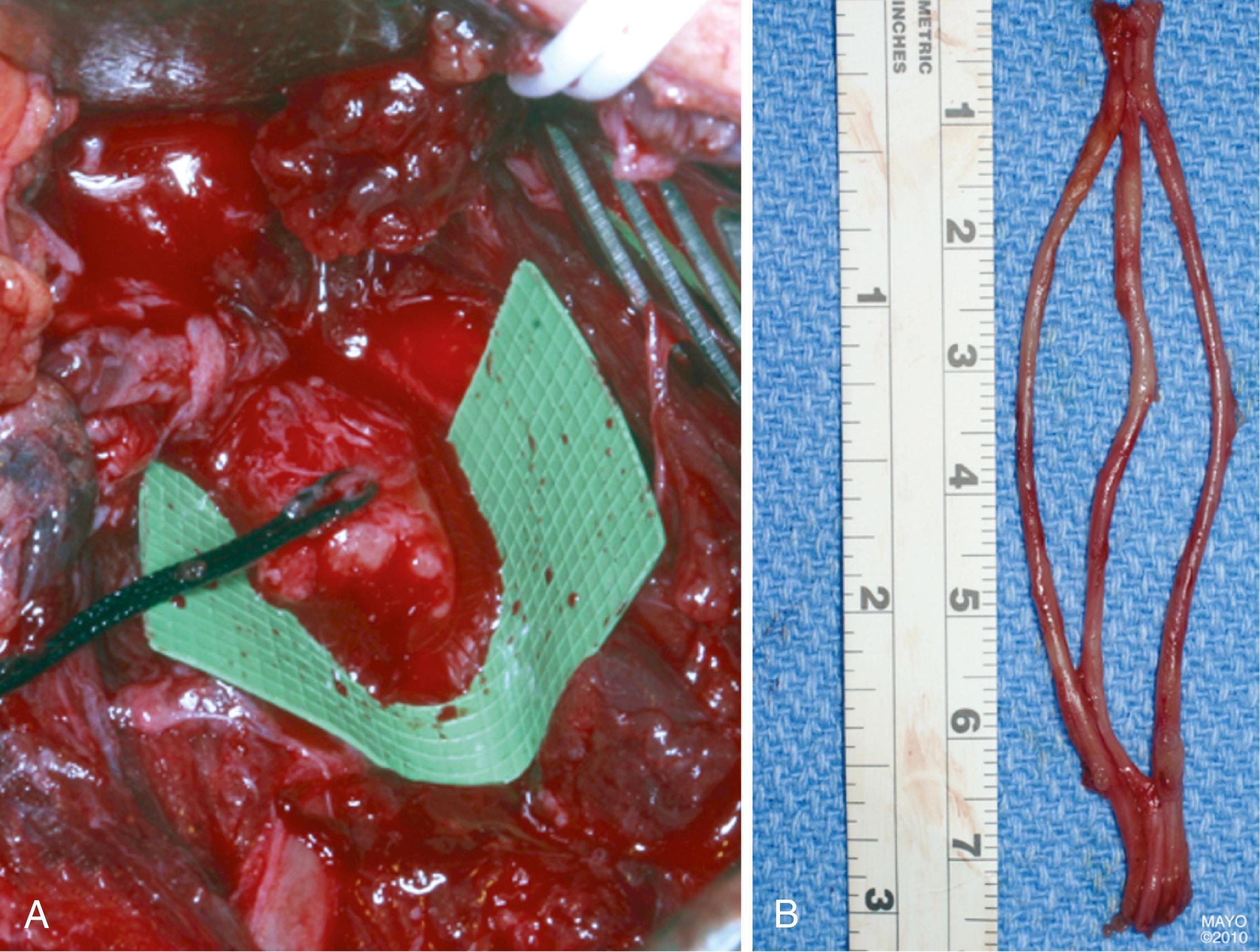 Fig. 34.15, A, A ruptured C5 nerve is being used as the donor axonal source. B, Three sural grafts have been prepared in a cable to reconstruct shoulder targets.