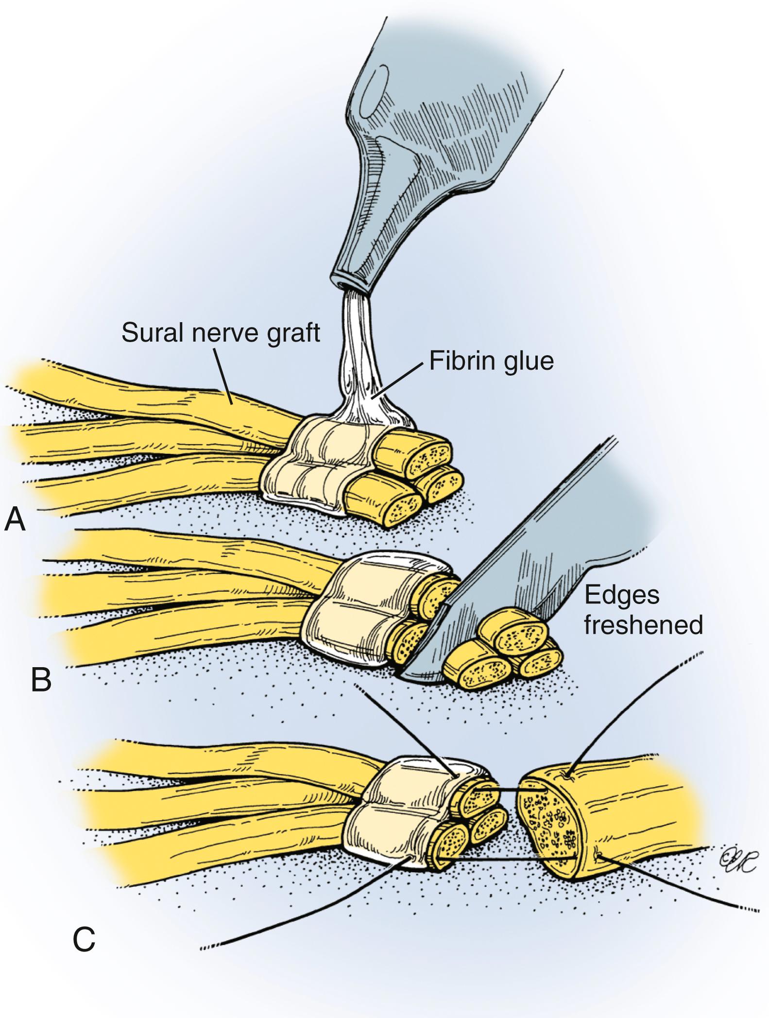 Fig. 34.16, Nerve repair with tissue adhesive. The graft strands are first glued together (A) . The graft ends are freshened with a sharp blade (B) and then coapted with conventional epineurial sutures (C) .