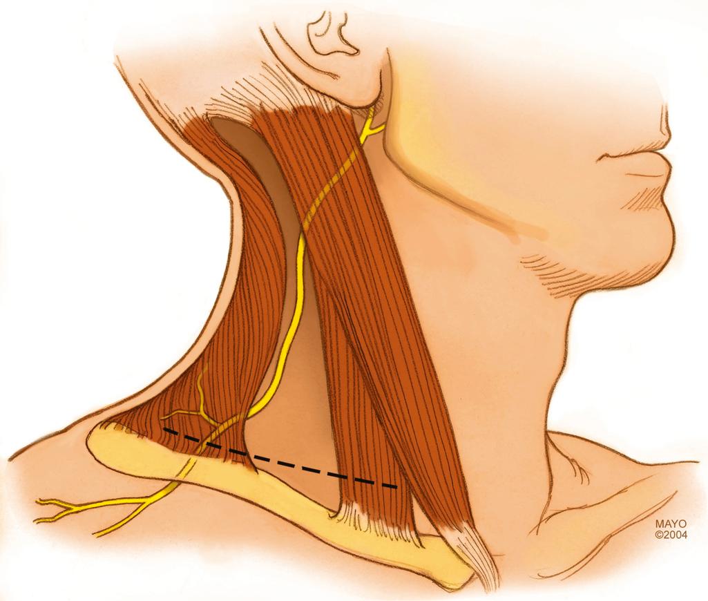 Fig. 34.17, The course of the spinal accessory nerve. The nerve can readily be identified in the lateral portion of a supraclavicular incision on the anterior surface of the trapezius muscle several centimeters above the clavicle.