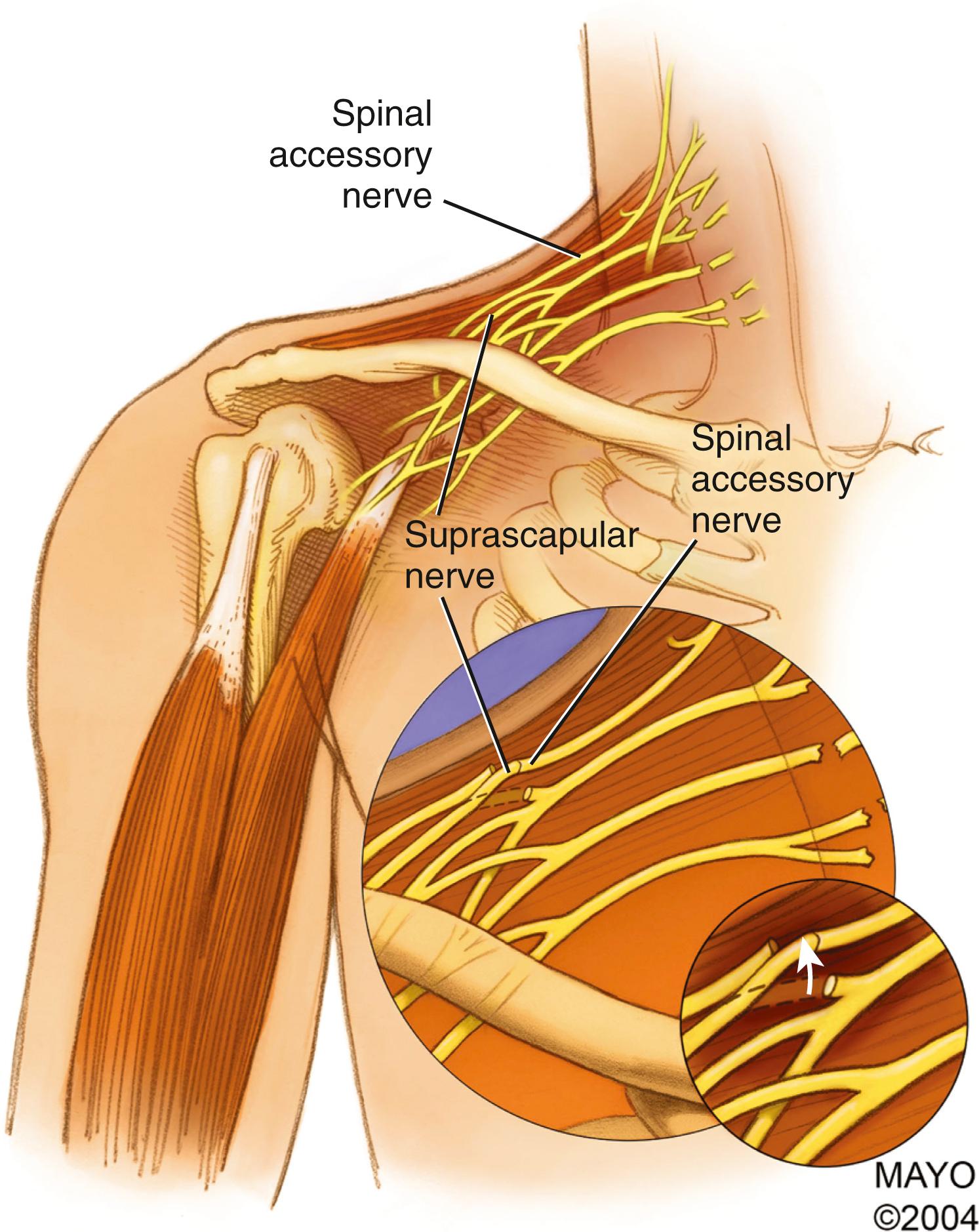 Fig. 34.18, Transfer of the spinal accessory nerve to the suprascapular nerve.