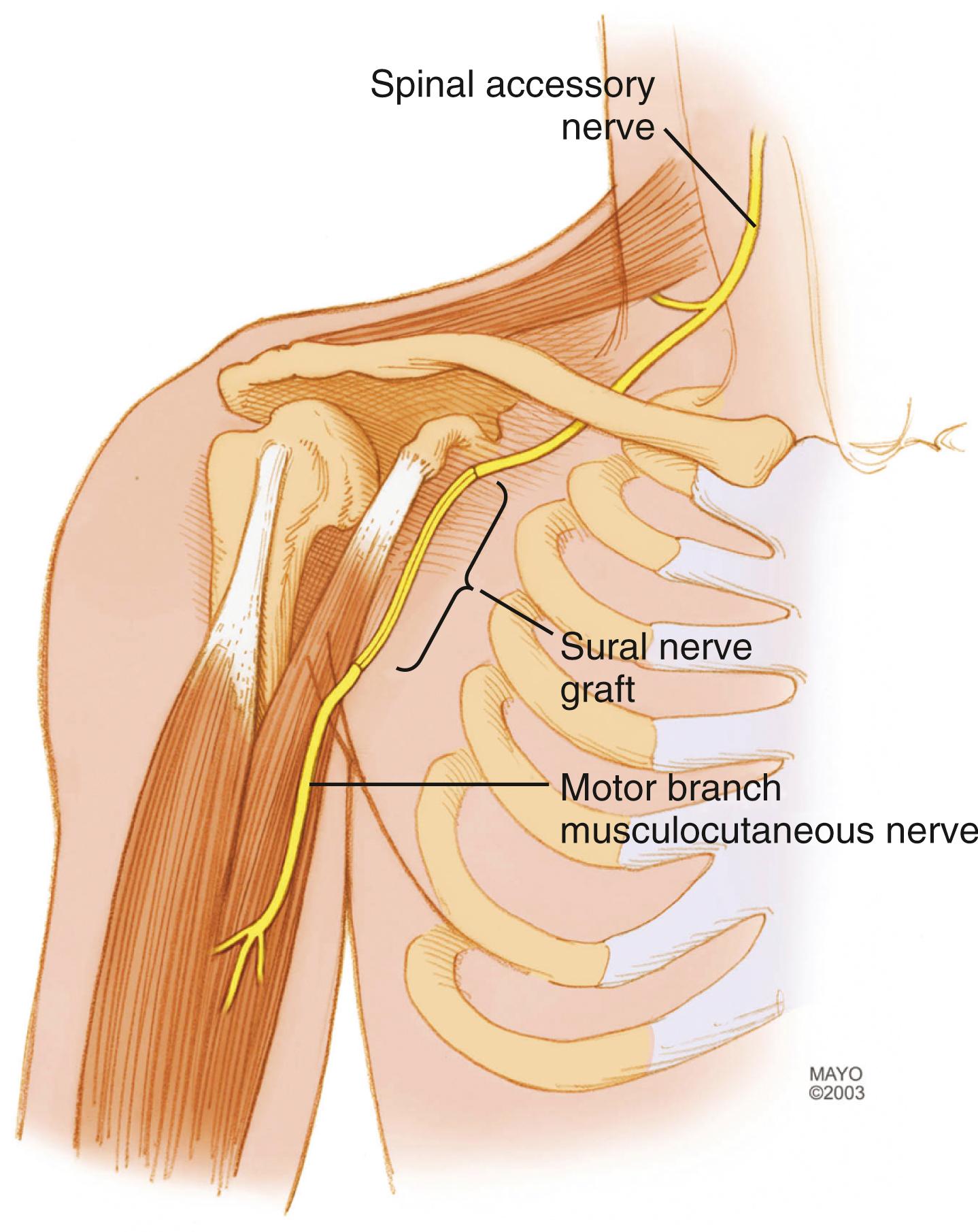 Fig. 34.20, The spinal accessory nerve can be used to transfer to the musculocutaneous nerve (as shown) or the biceps and brachialis branches with an interposition graft.