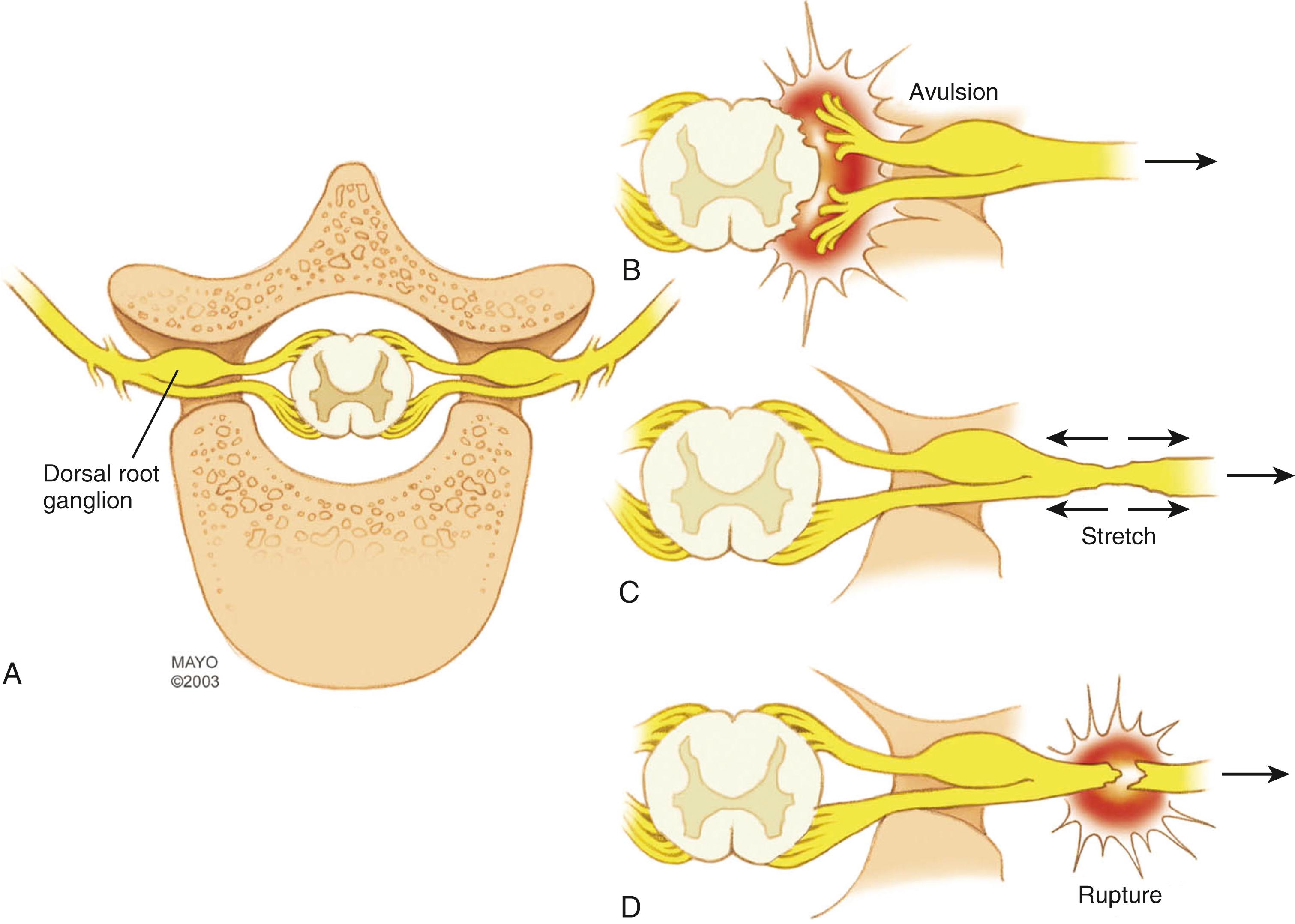 Fig. 34.2, A to D, Traction injury to the brachial plexus may cause nerve injuries of varying severity in the same patient. Such injuries include avulsion (preganglionic injury) of nerve roots from the spinal cord (for practical purposes, cannot be repaired), stretch (postganglionic injury) of different magnitudes (sometimes spontaneous recovery possible), and extraforaminal rupture of the nerve or trunk (can be repaired with surgery).