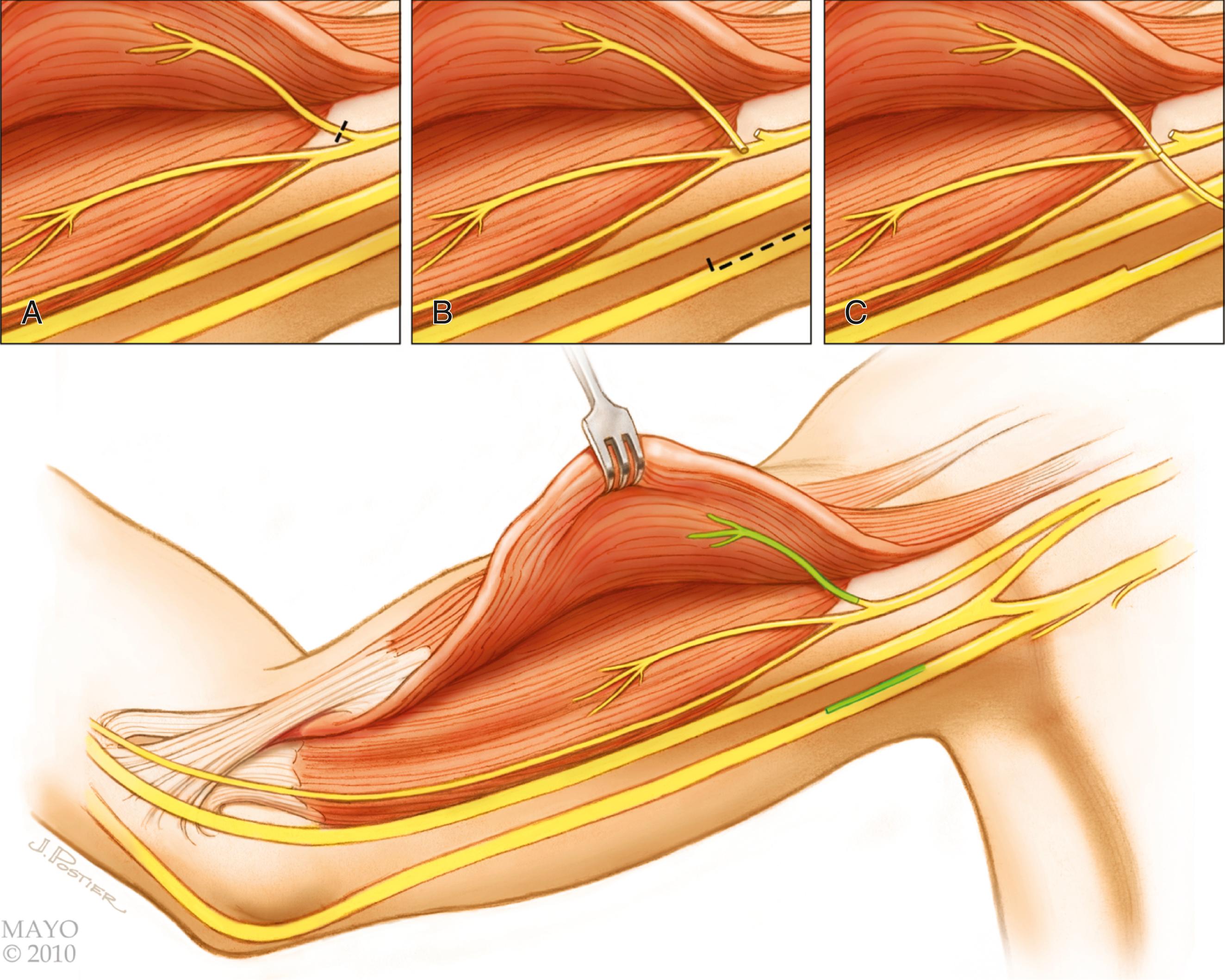 Fig. 34.21, Ulnar fascicular transfer to the biceps motor branch (Oberlin method). A, The biceps motor branch is identified and carefully dissected from the musculocutaneous nerve. B, The ulnar nerve undergoes internal neurolysis, and a nerve stimulator is used to choose an appropriately sized fascicle for stimulation of wrist flexion without stimulation of intrinsic hand function. C, The ulnar nerve fascicle is divided and transferred under an operative microscope to the biceps motor branch.