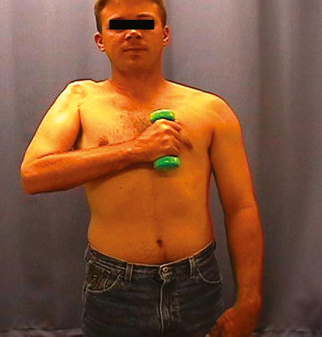 Fig. 34.23, Excellent recovery of biceps bulk and strength after an ulnar nerve fascicular transfer.