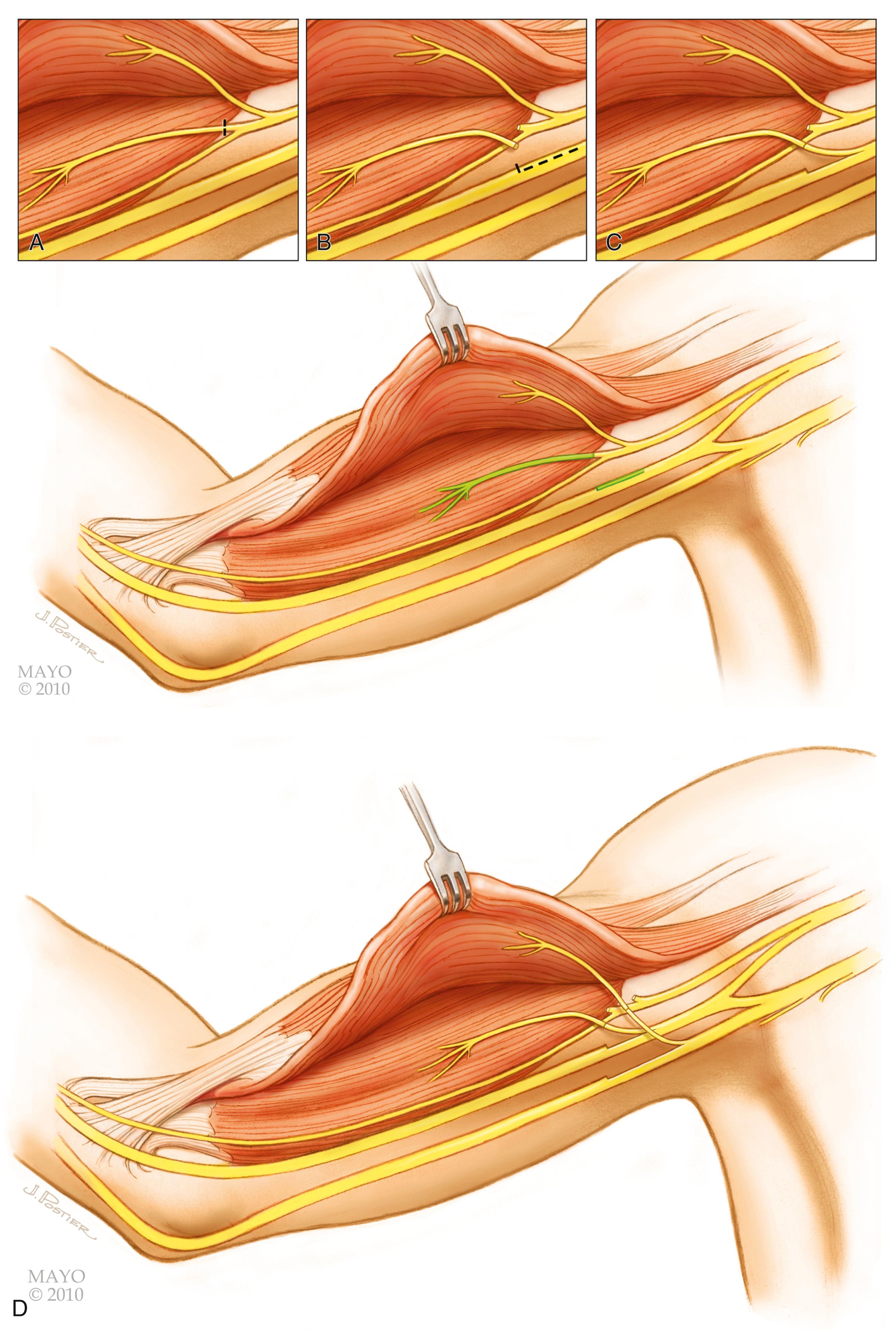 Fig. 34.24, Median fascicular transfer to the brachialis motor branch. A, The brachialis motor branch is identified and carefully dissected from the musculocutaneous nerve. B, The median nerve is identified and undergoes internal neurolysis. A nerve stimulator is used to identify an appropriately sized fascicle that stimulates the wrist flexors. C, The median nerve fascicle is then transferred to the brachialis motor branch under the operative microscope. D, This technique is often done in conjunction with ulnar nerve fascicular transfer to the biceps branch.