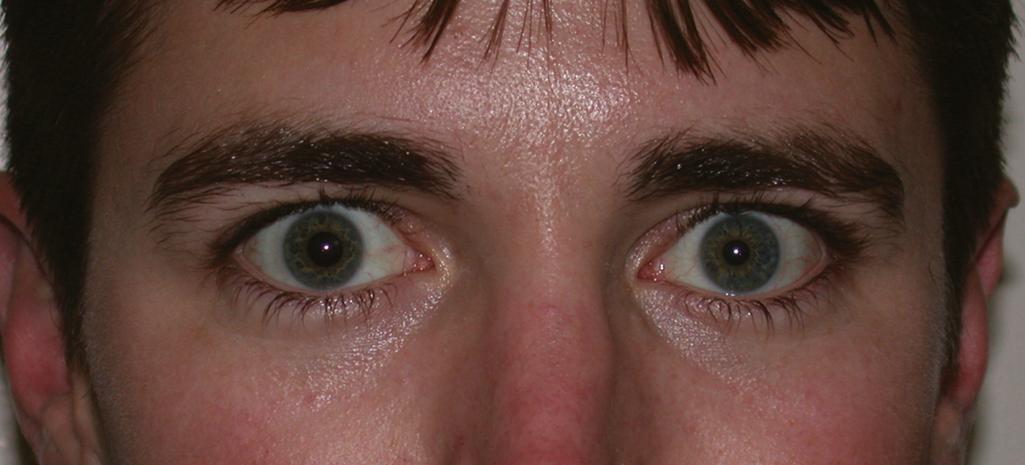 Fig. 34.5, The presence of Horner syndrome (i.e., ptosis, miosis, anhidrosis, and enophthalmos caused by paralysis of the sympathetic nerves), as seen in the left eye, is associated with avulsion of the C8 and T1 nerve roots.