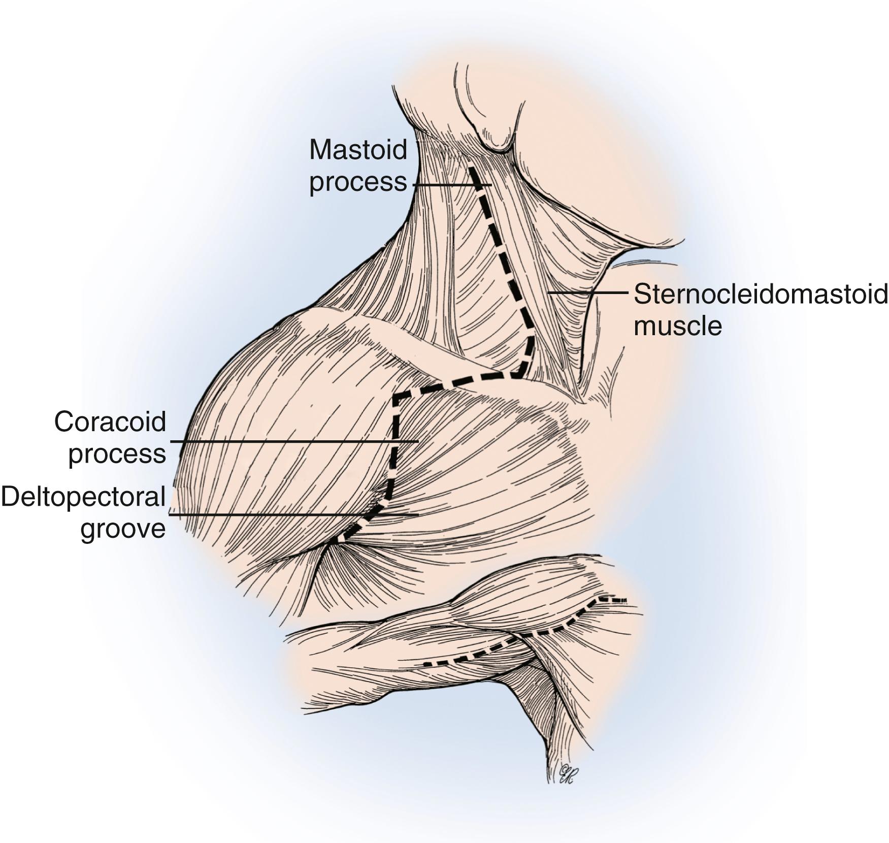 Fig. 34.7, Classic zigzag skin incision used for exploration of the brachial plexus from the vertebral foramen to the terminal branch level in patients with traumatic brachial plexus injuries. The distal limb of the incision can be extended into the arm as needed.