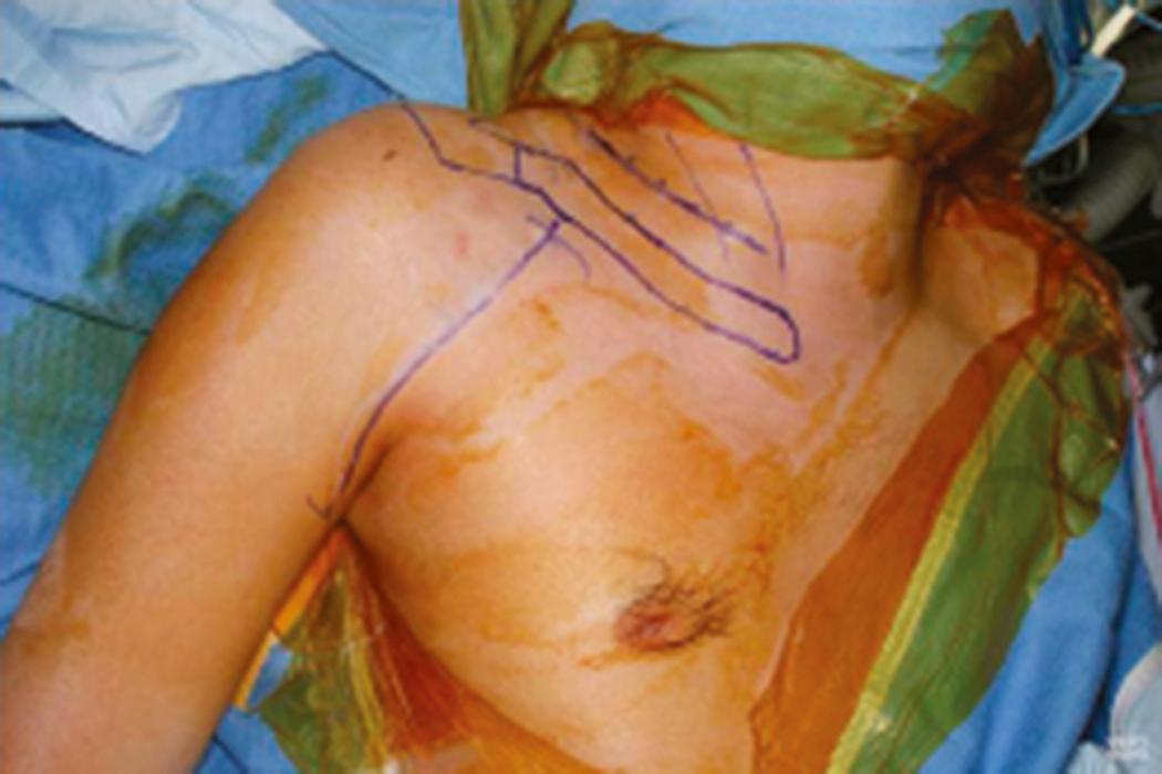 Fig. 34.8, Our preferred skin incisions for surgical exploration of the brachial plexus. A transverse neck incision allows exposure of the supraclavicular brachial plexus and spinal accessory nerve. A deltopectoral skin incision allows exposure of the infraclavicular portion of the brachial plexus.